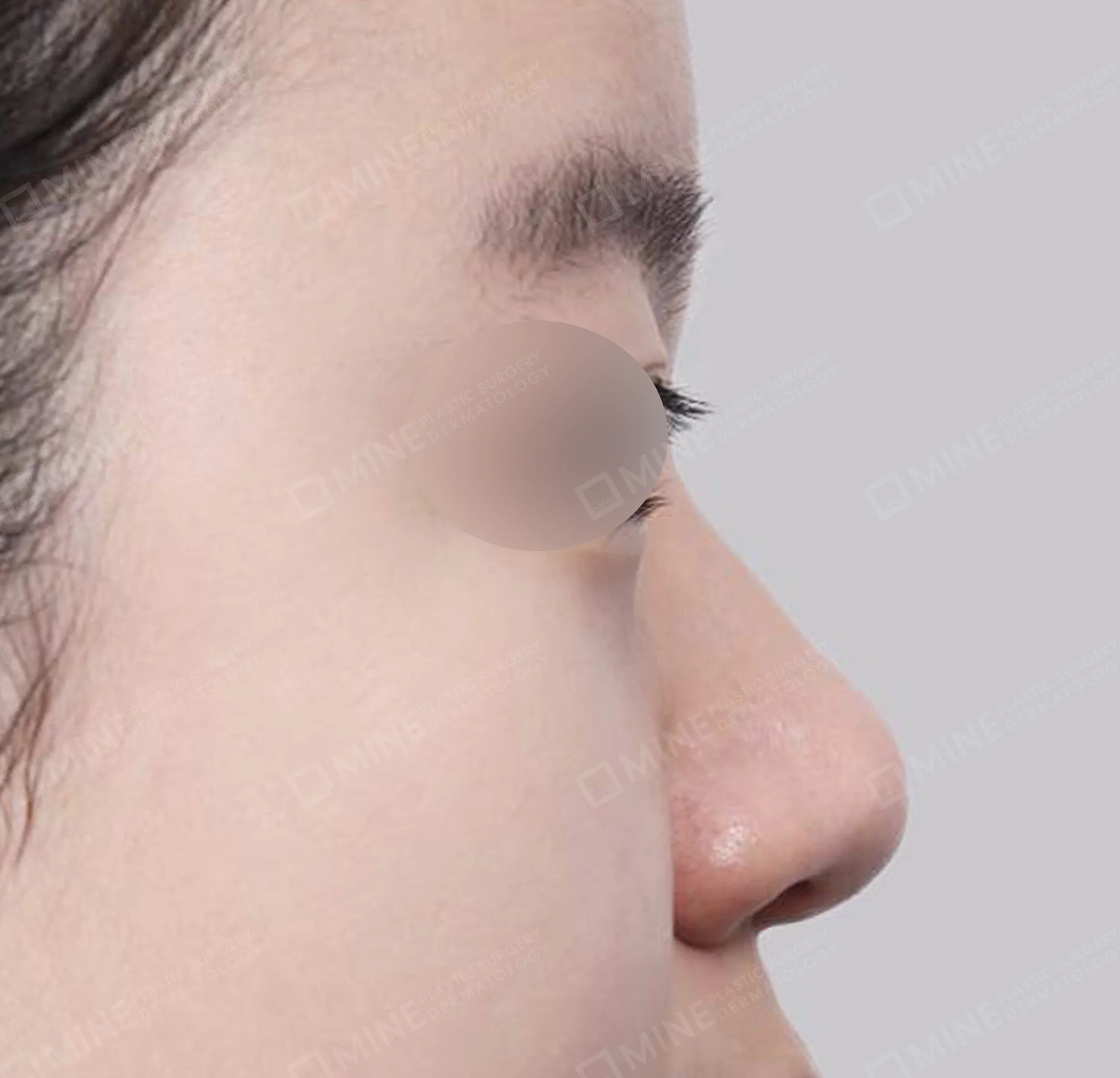 Hidung Punuk + Osteotomi + Pengecilan Lubang Hidung + Batang Hidung-Samping-Sebelum