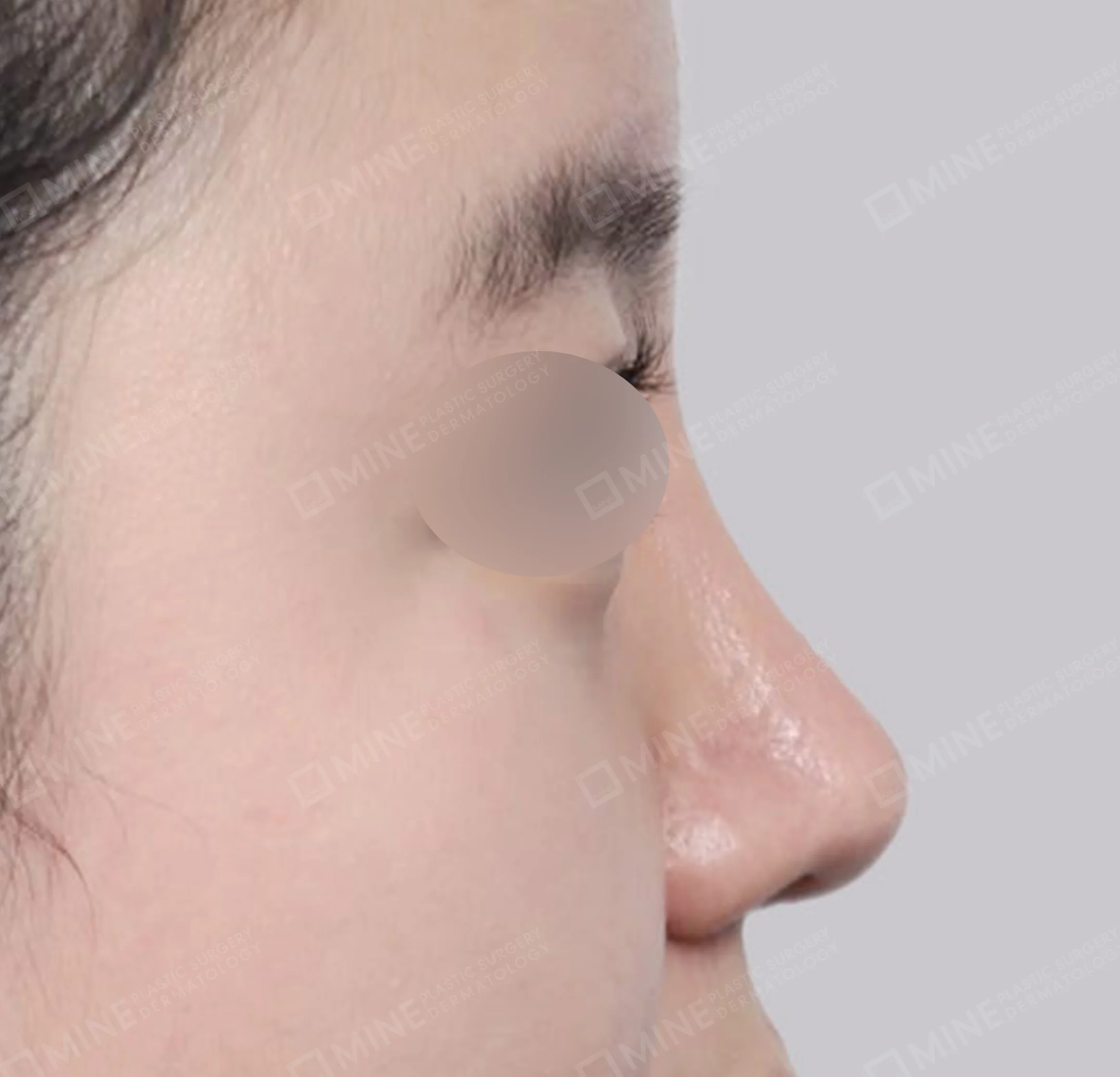 Hidung Punuk + Osteotomi + Pengecilan Lubang Hidung + Batang Hidung-Samping-Sesudah