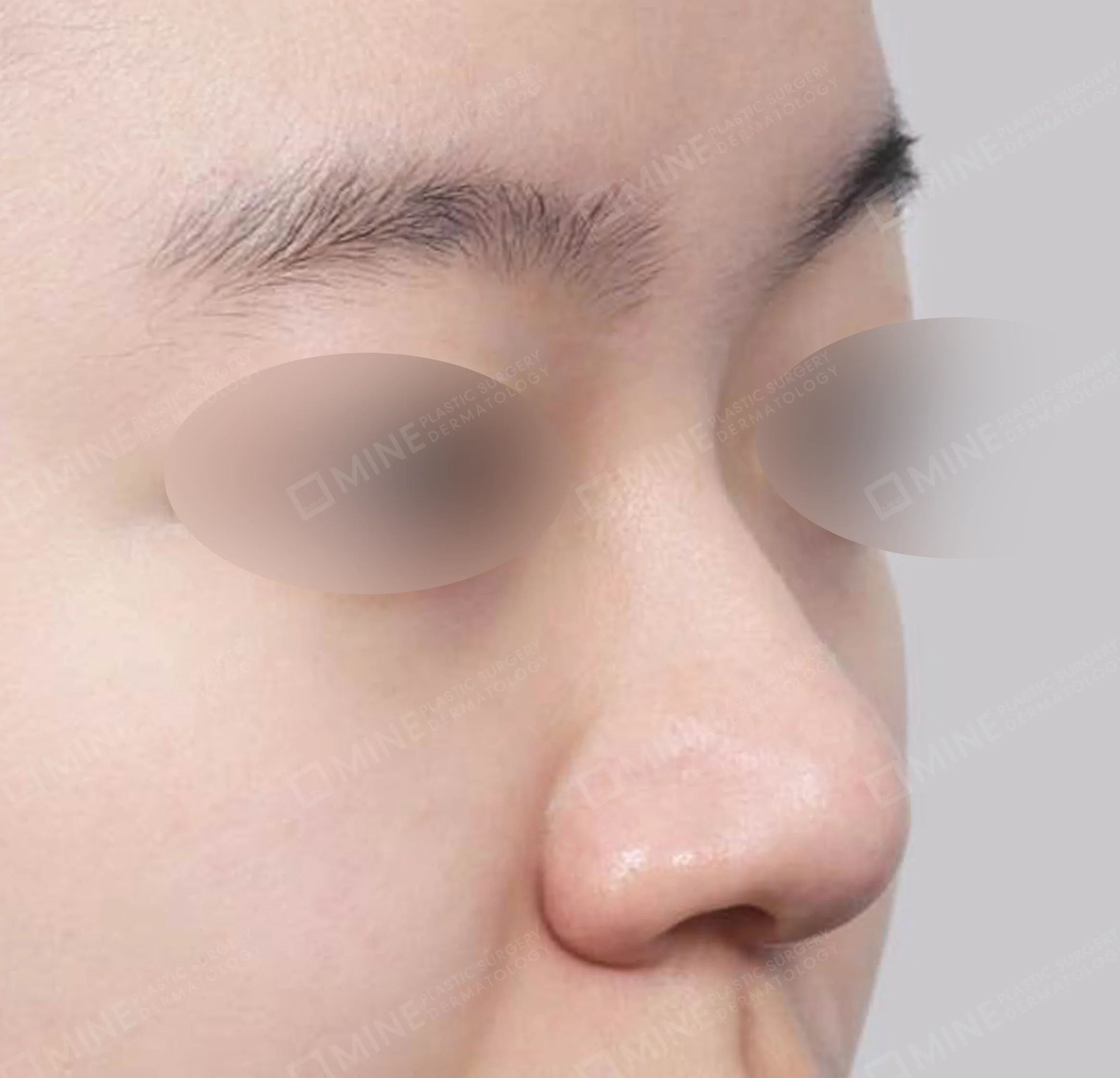 Hidung Punuk + Osteotomi + Pengecilan Lubang Hidung + Batang Hidung-45 Derajat-Sebelum