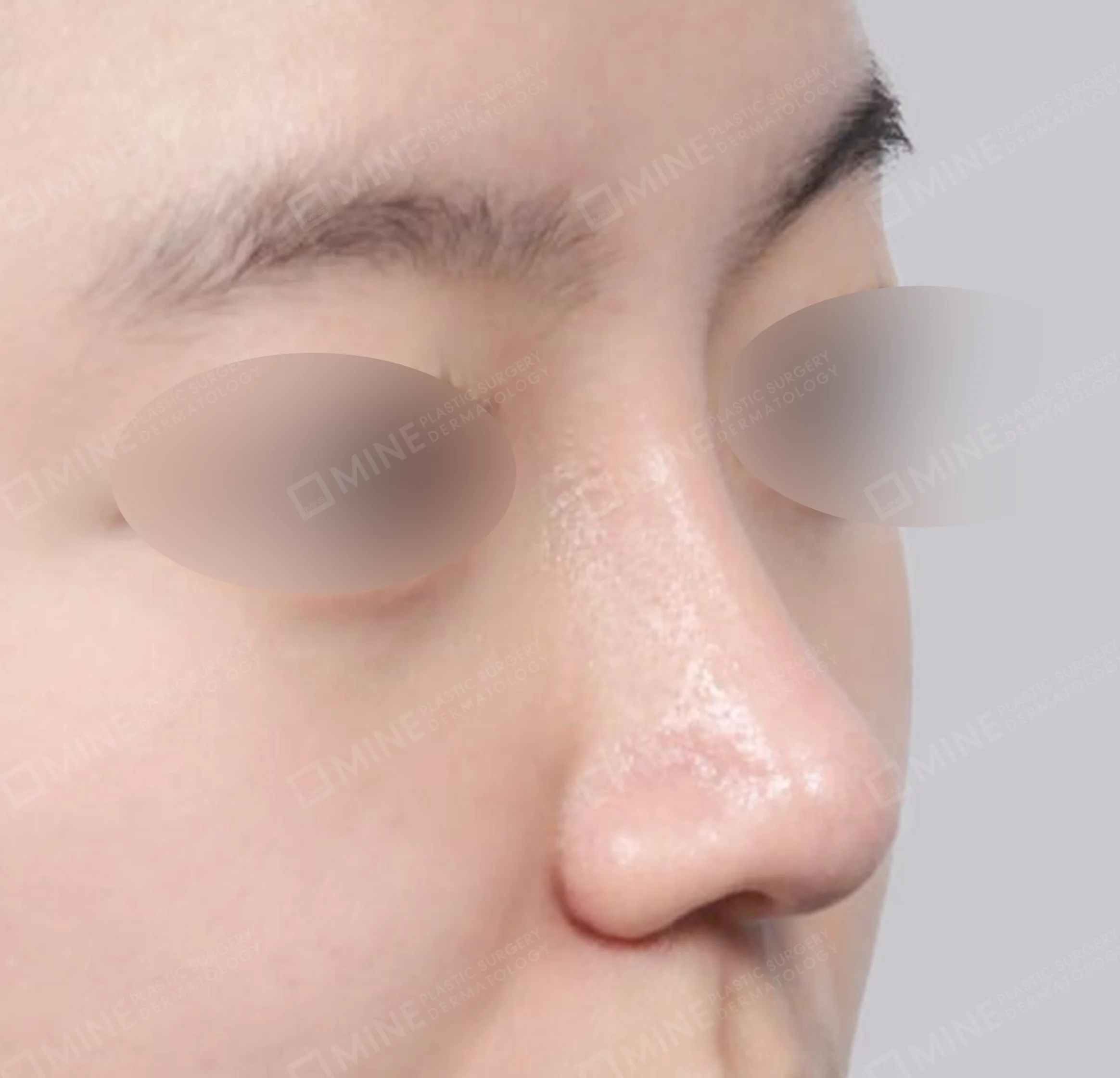 Hidung Punuk + Osteotomi + Pengecilan Lubang Hidung + Batang Hidung-45 Derajat-Sesudah