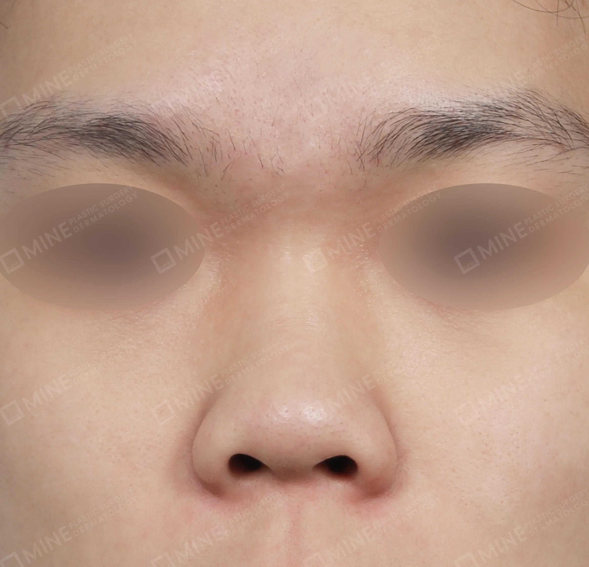Hidung Punuk + Batang Hidung + Pemanjangan Septum Hidung + Pengurangan Ujung Hidung-Depan-Sebelum