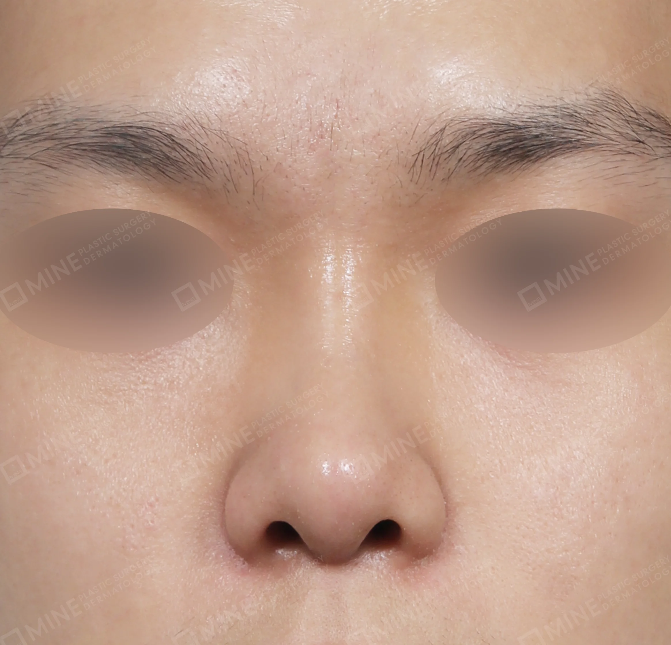 Hidung Punuk + Batang Hidung + Pemanjangan Septum Hidung + Pengurangan Ujung Hidung-Depan-Sesudah
