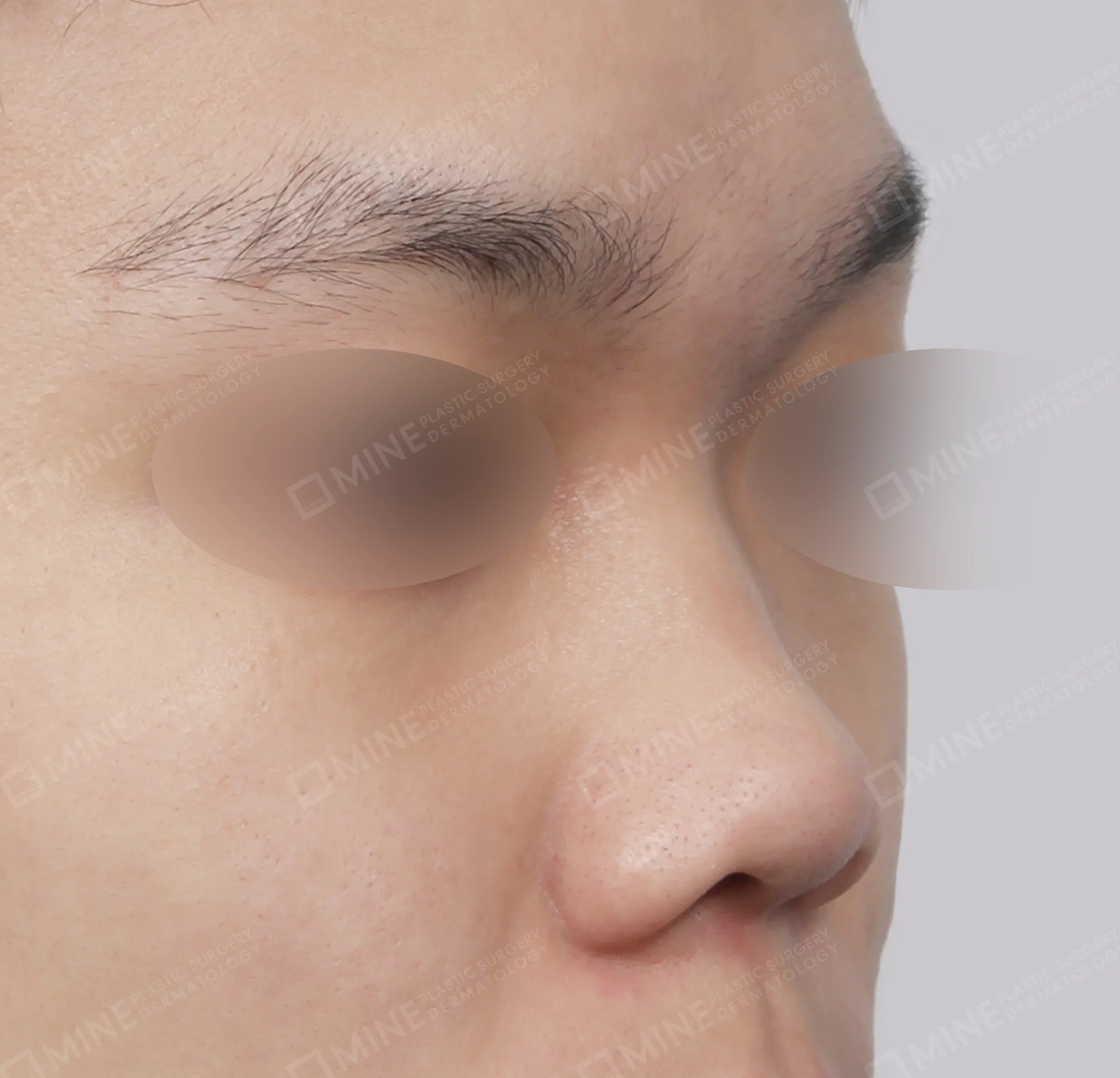 Hidung Punuk + Batang Hidung + Pemanjangan Septum Hidung + Pengurangan Ujung Hidung-Samping-Sebelum