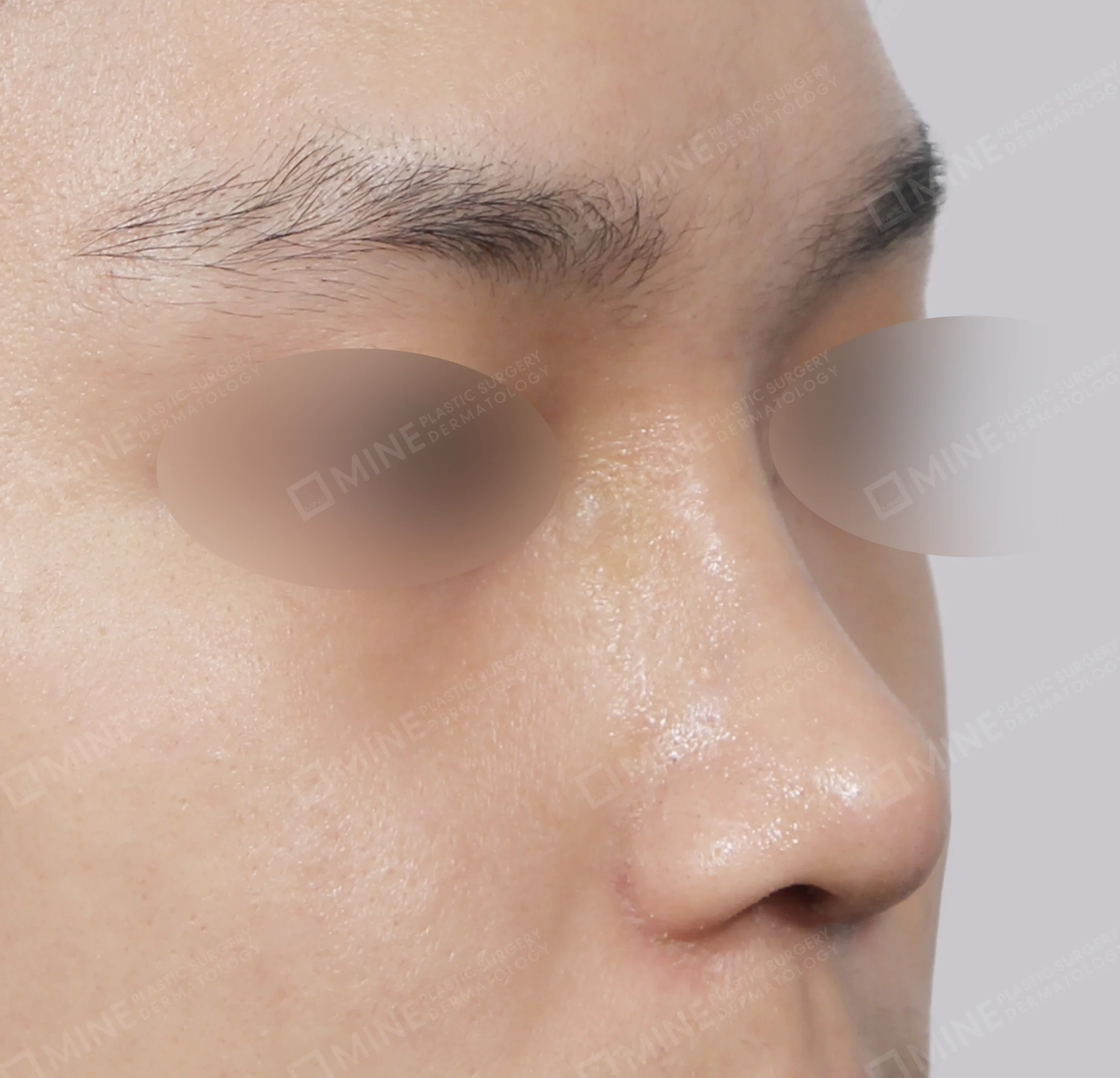Hidung Punuk + Batang Hidung + Pemanjangan Septum Hidung + Pengurangan Ujung Hidung-Samping-Sesudah