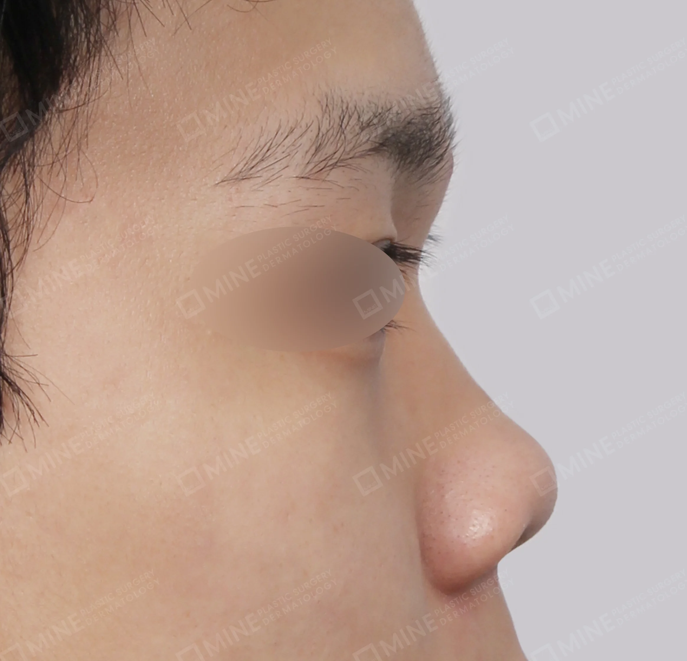 Hidung Punuk + Batang Hidung + Pemanjangan Septum Hidung + Pengurangan Ujung Hidung-45 Derajat-Sebelum