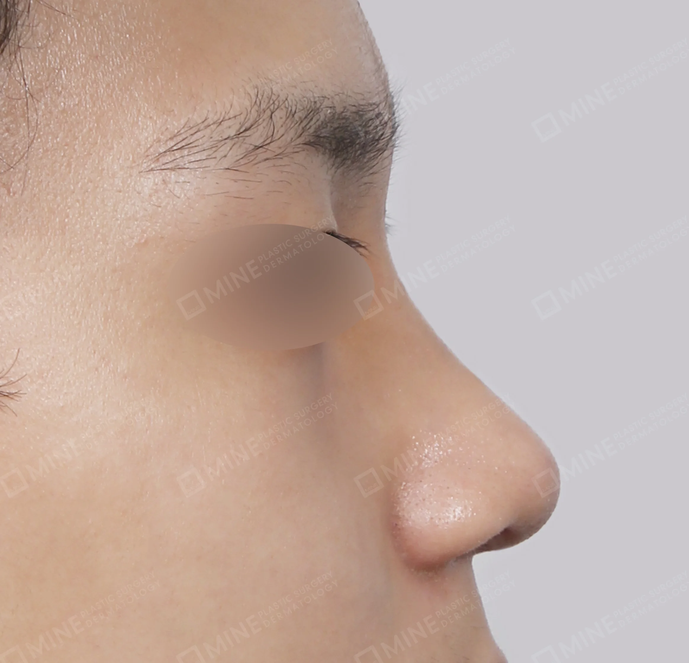 Hidung Punuk + Batang Hidung + Pemanjangan Septum Hidung + Pengurangan Ujung Hidung-45 Derajat-Sesudah