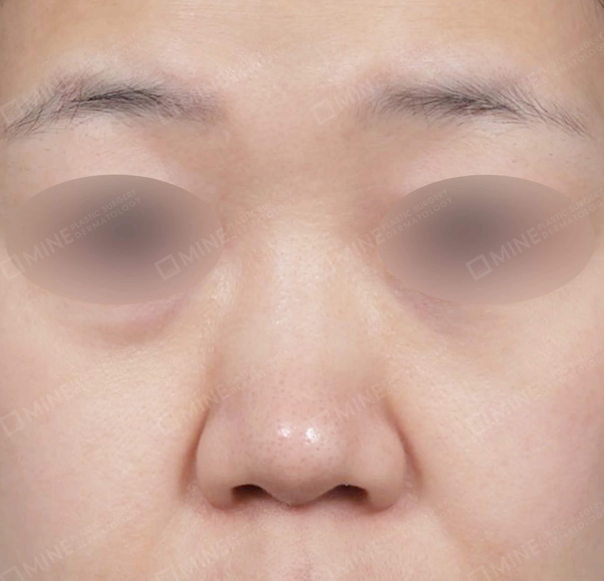 Batang Hidung + Pengurangan Ujung Hidung + Pengecilan Lubang Hidung + Pemanjangan Septum Hidung-Depan-Sebelum