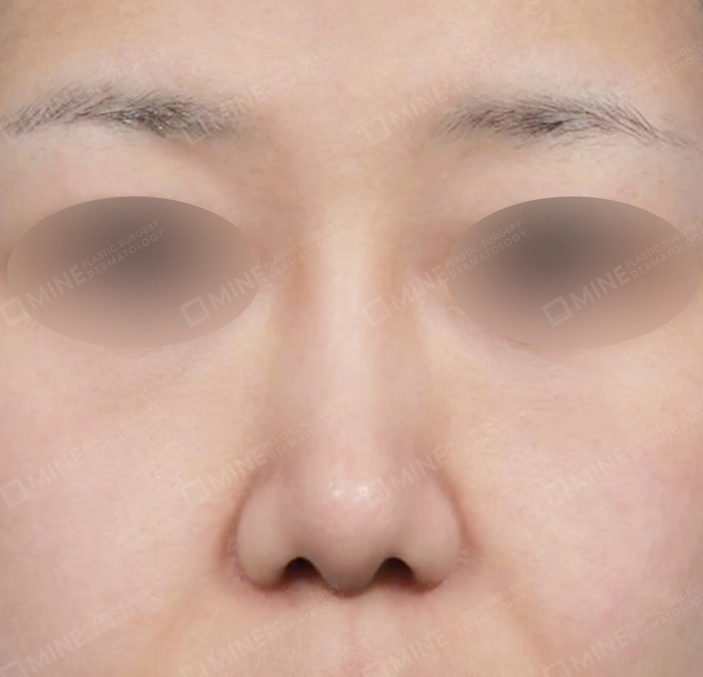 Batang Hidung + Pengurangan Ujung Hidung + Pengecilan Lubang Hidung + Pemanjangan Septum Hidung-Depan-Sesudah