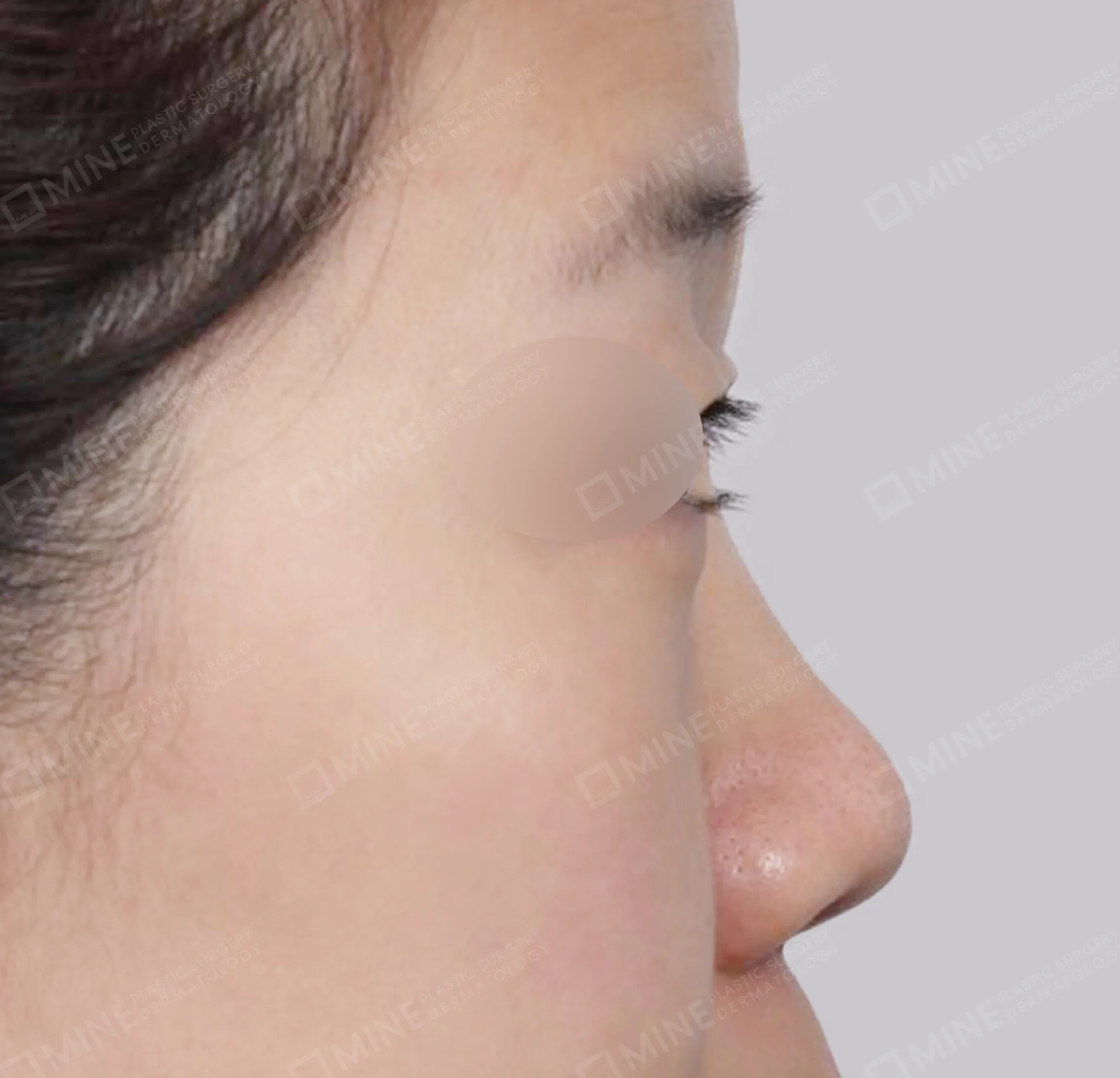Batang Hidung + Pengurangan Ujung Hidung + Pengecilan Lubang Hidung + Pemanjangan Septum Hidung-Samping-Sebelum