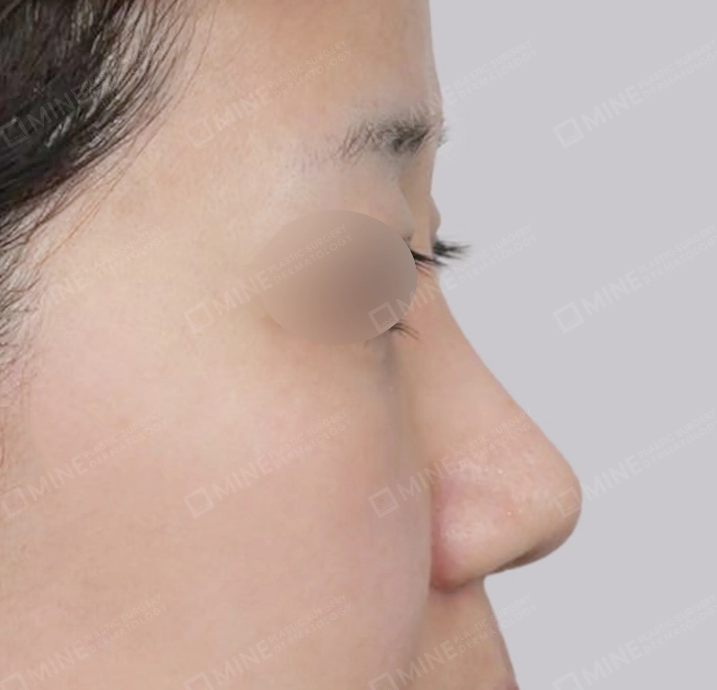 Batang Hidung + Pengurangan Ujung Hidung + Pengecilan Lubang Hidung + Pemanjangan Septum Hidung-Samping-Sesudah