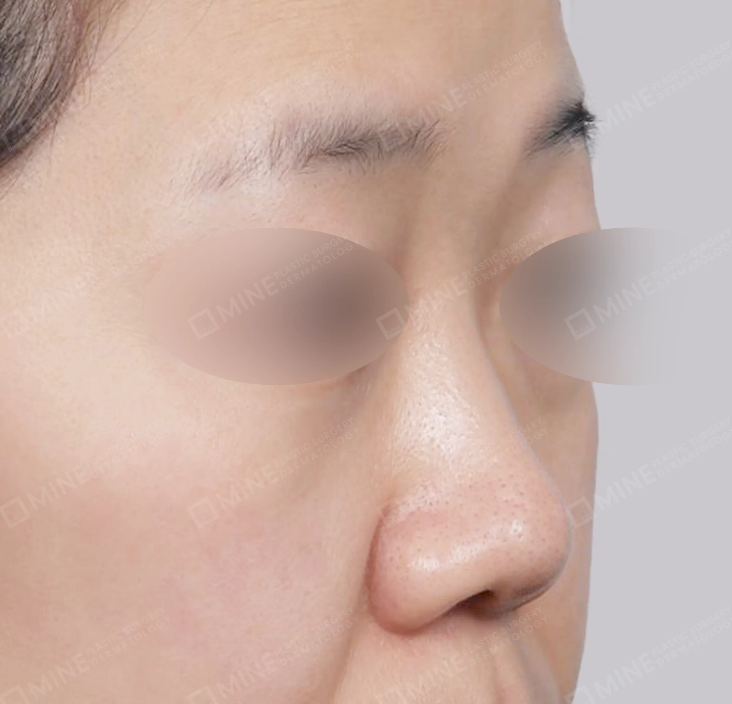 Batang Hidung + Pengurangan Ujung Hidung + Pengecilan Lubang Hidung + Pemanjangan Septum Hidung-45 Derajat-Sebelum