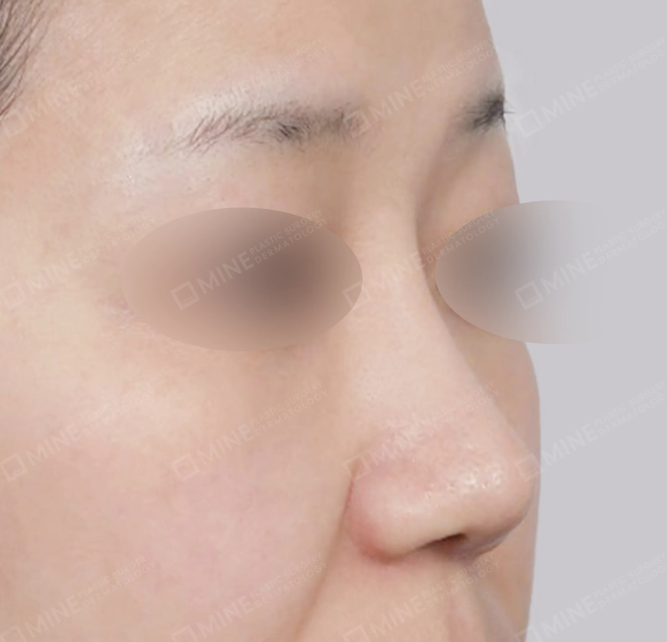 Batang Hidung + Pengurangan Ujung Hidung + Pengecilan Lubang Hidung + Pemanjangan Septum Hidung-45 Derajat-Sesudah