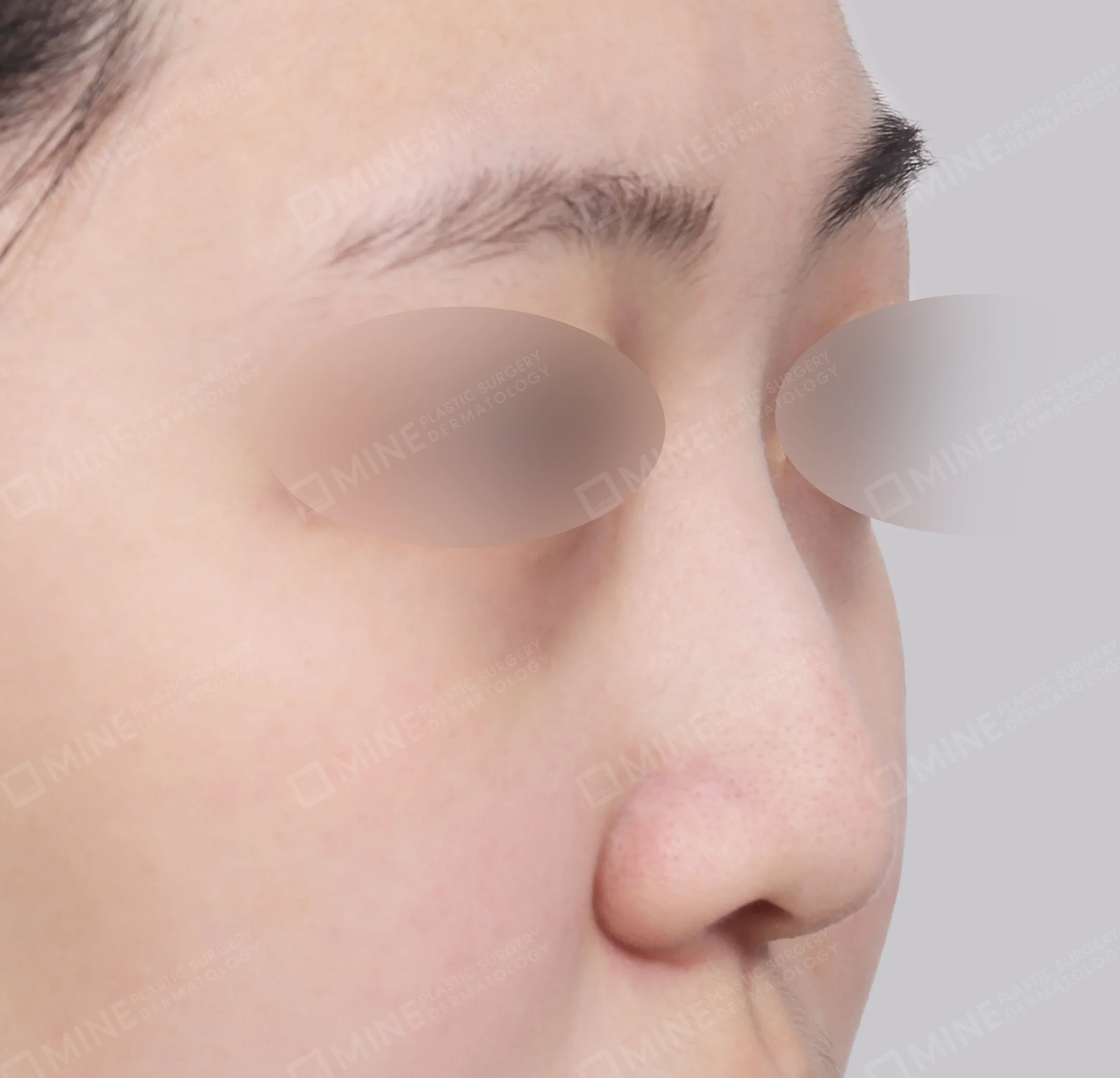 Koreksi Hidung Miring + Osteotomi + Ujung Hidung-Depan-Sebelum
