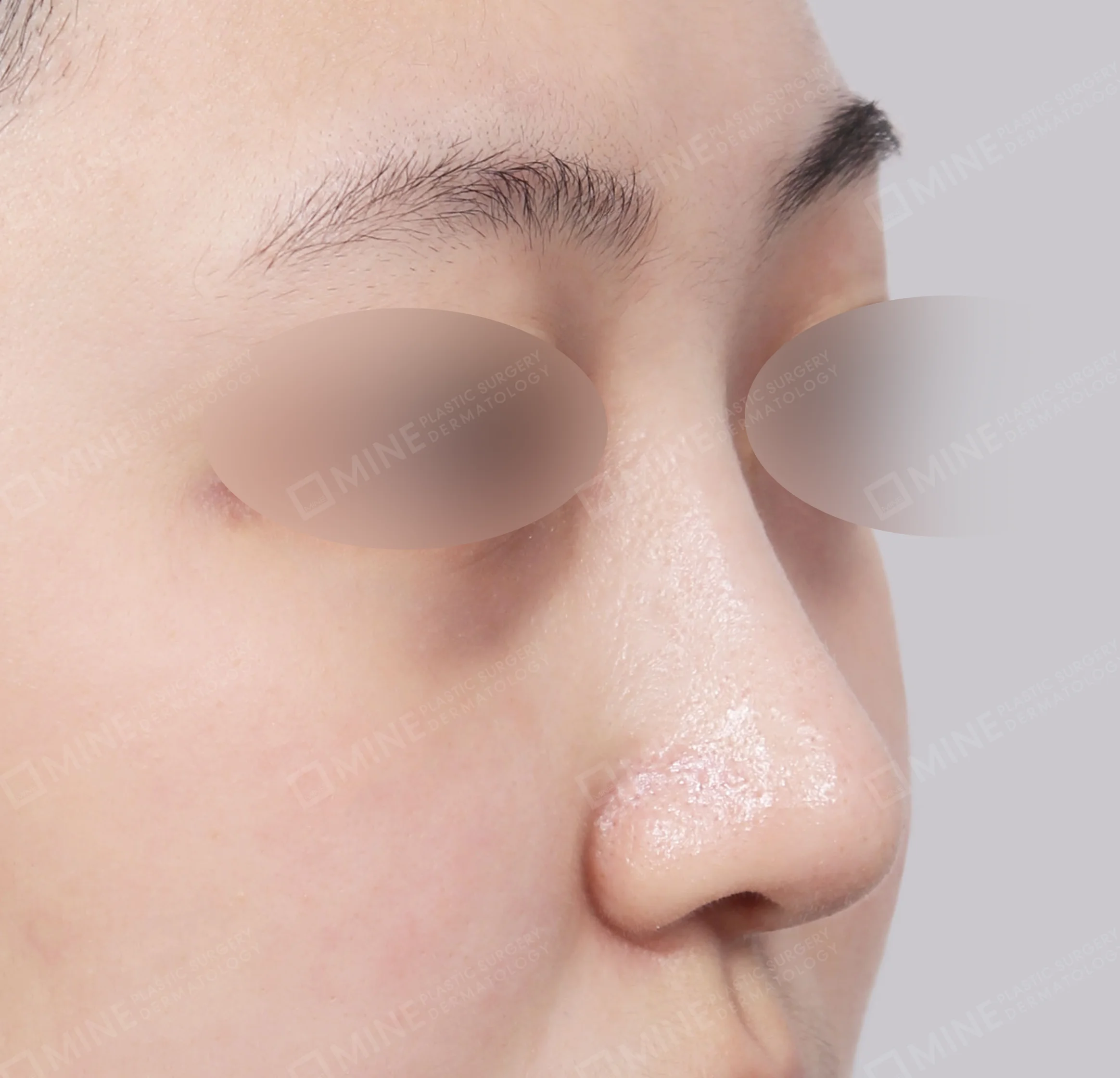 Koreksi Hidung Miring + Osteotomi + Ujung Hidung-Depan-Sesudah