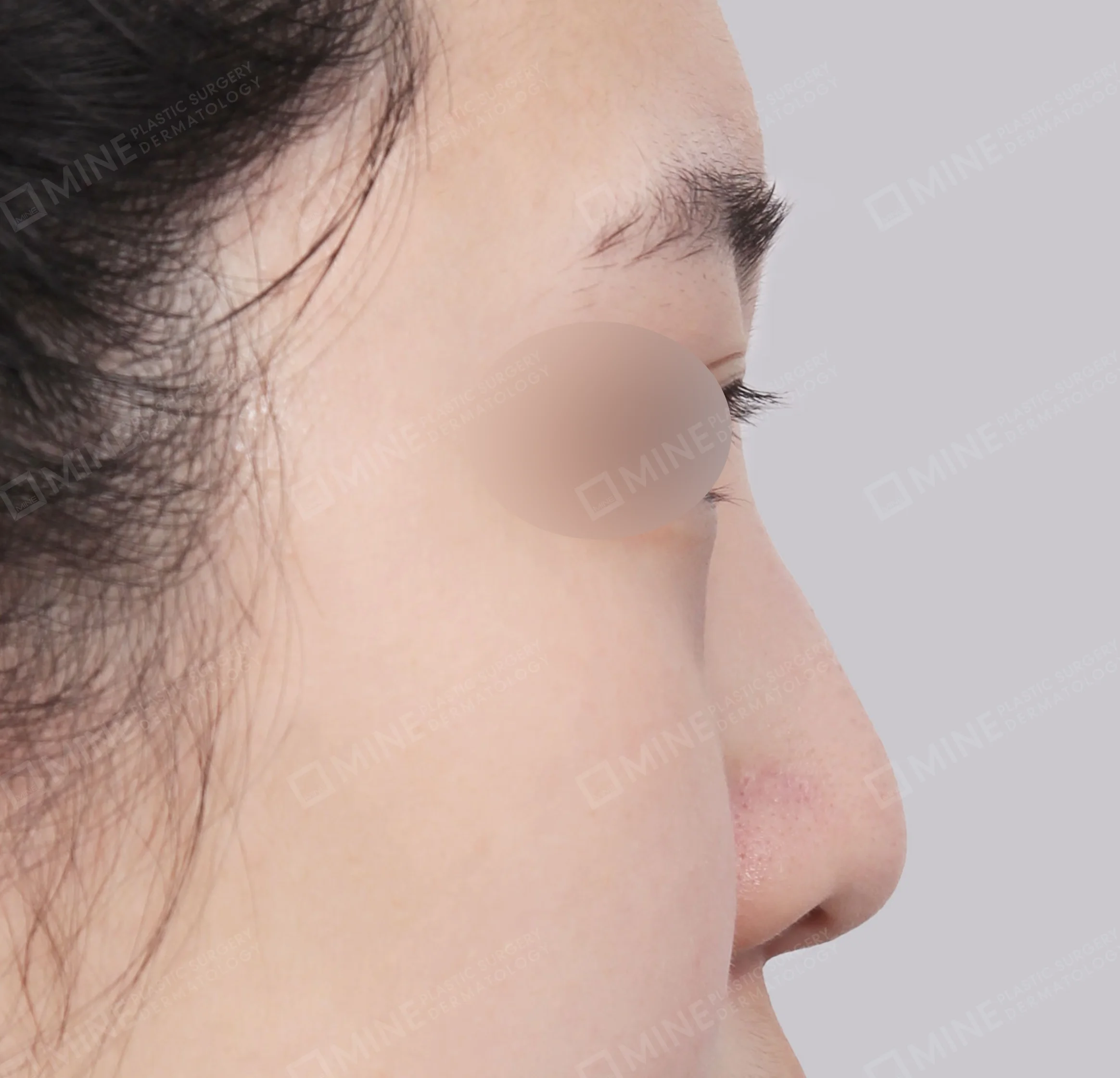 Koreksi Hidung Miring + Osteotomi + Ujung Hidung-Samping-Sebelum