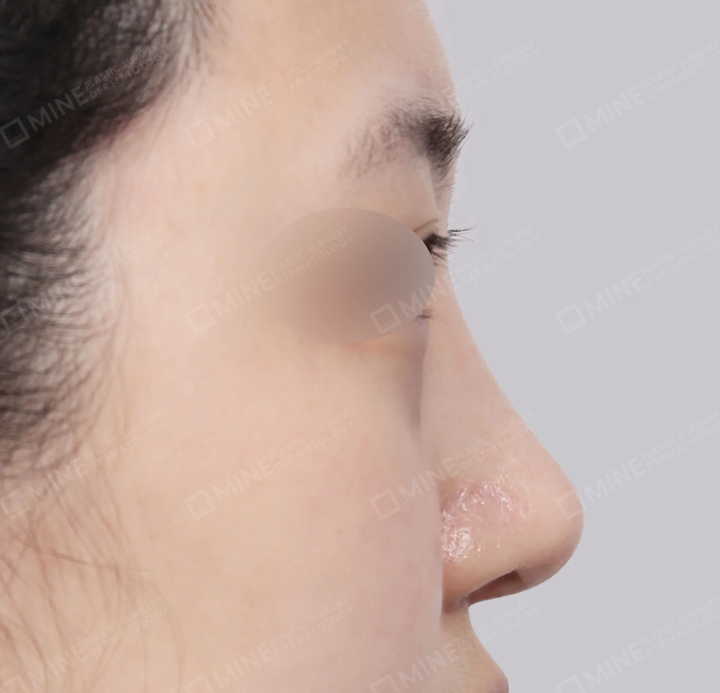 Koreksi Hidung Miring + Osteotomi + Ujung Hidung-Samping-Sesudah
