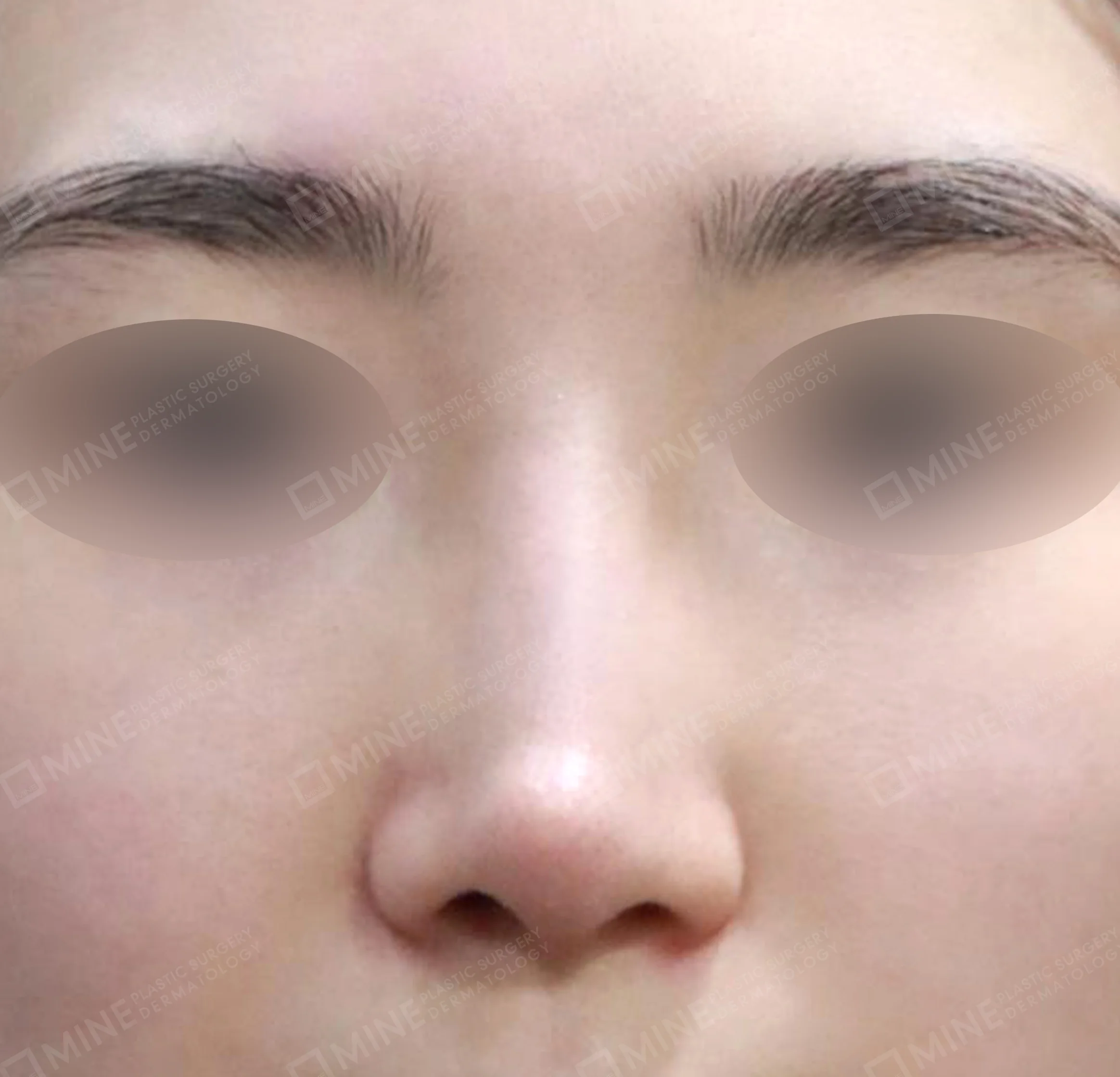 Revisi Operasi Hidung-Depan-Sebelum