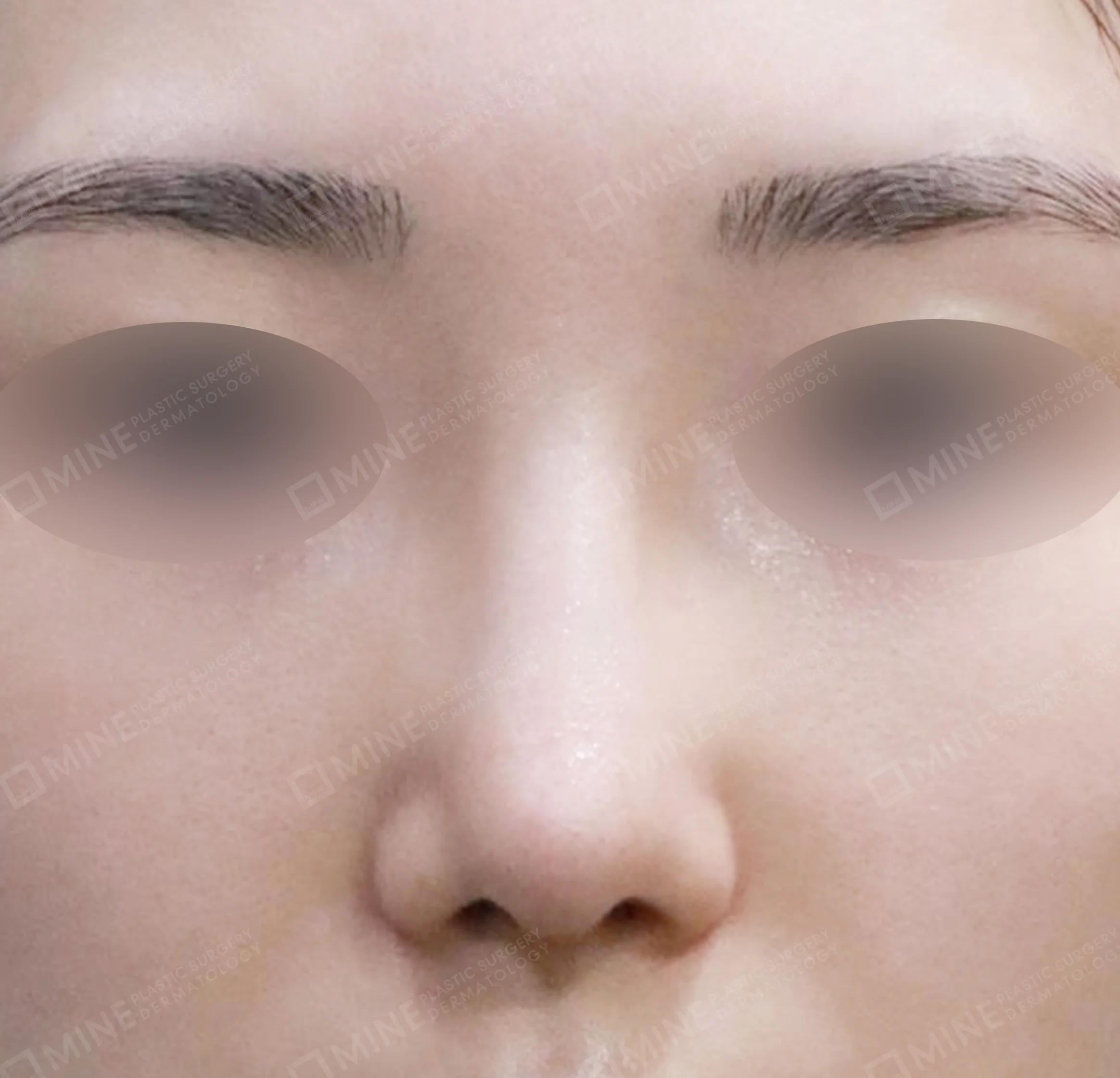 Revisi Operasi Hidung-Depan-Sesudah