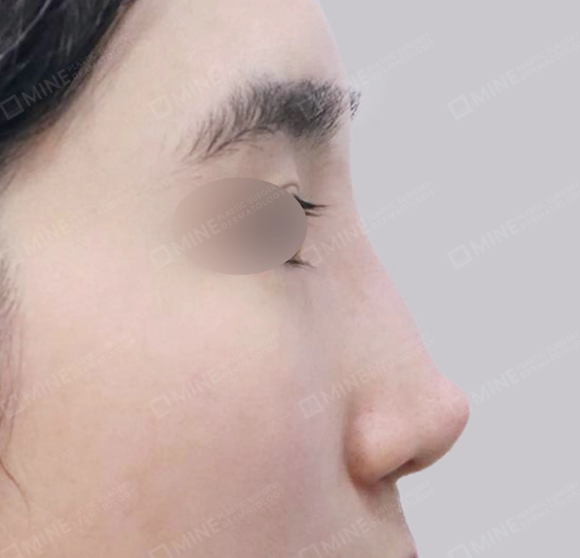 Revisi Operasi Hidung-Samping-Sebelum