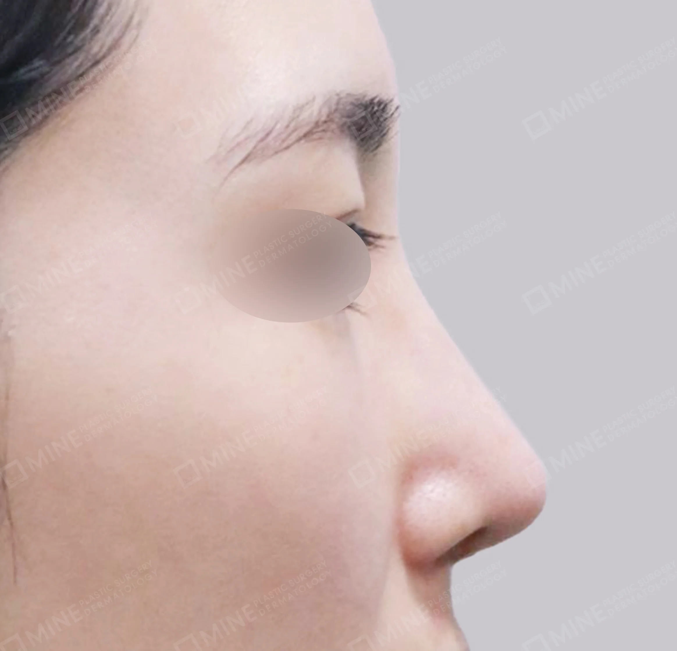 Revisi Operasi Hidung-Samping-Sesudah