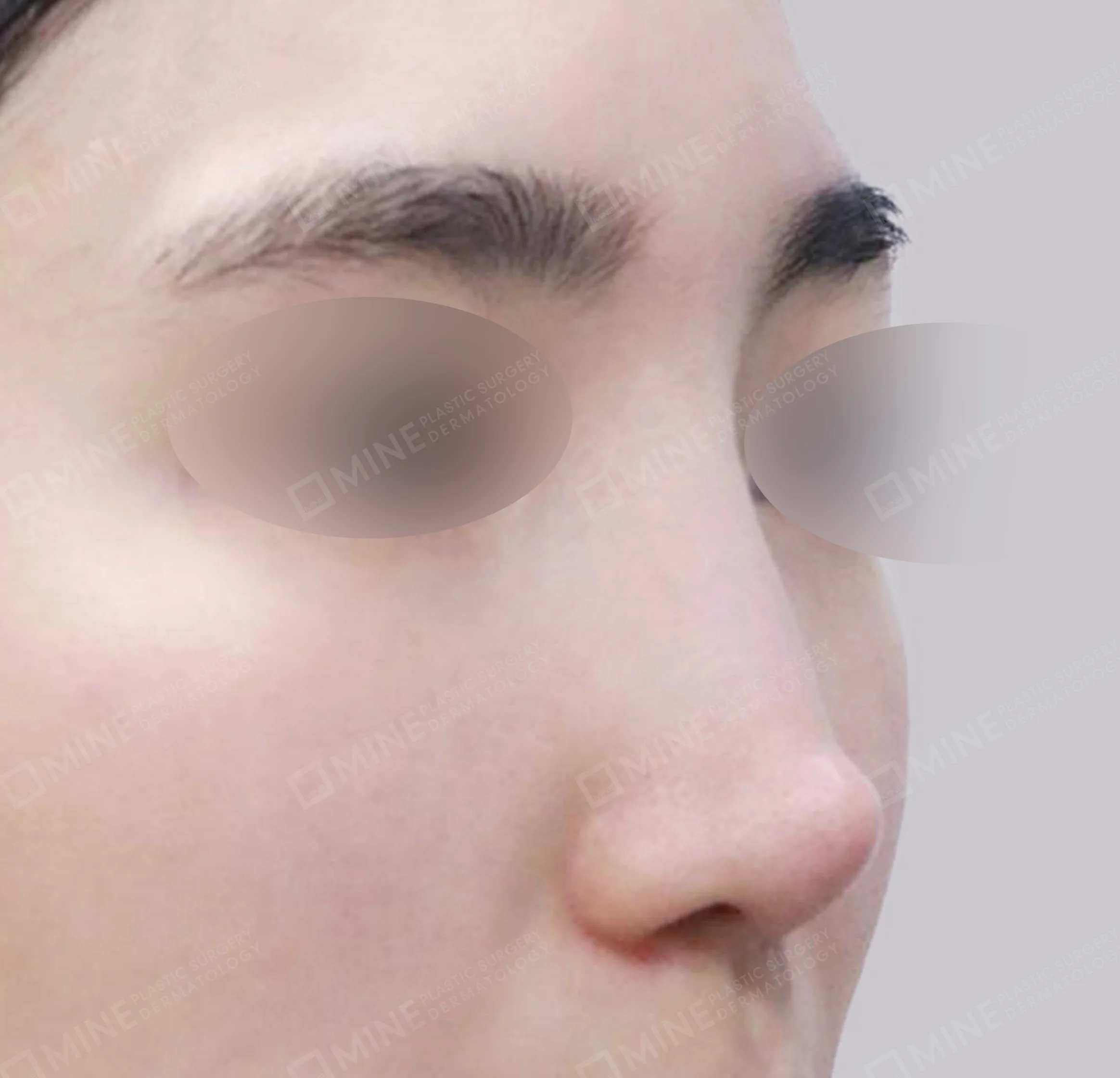 Revisi Operasi Hidung-45 Derajat-Sebelum