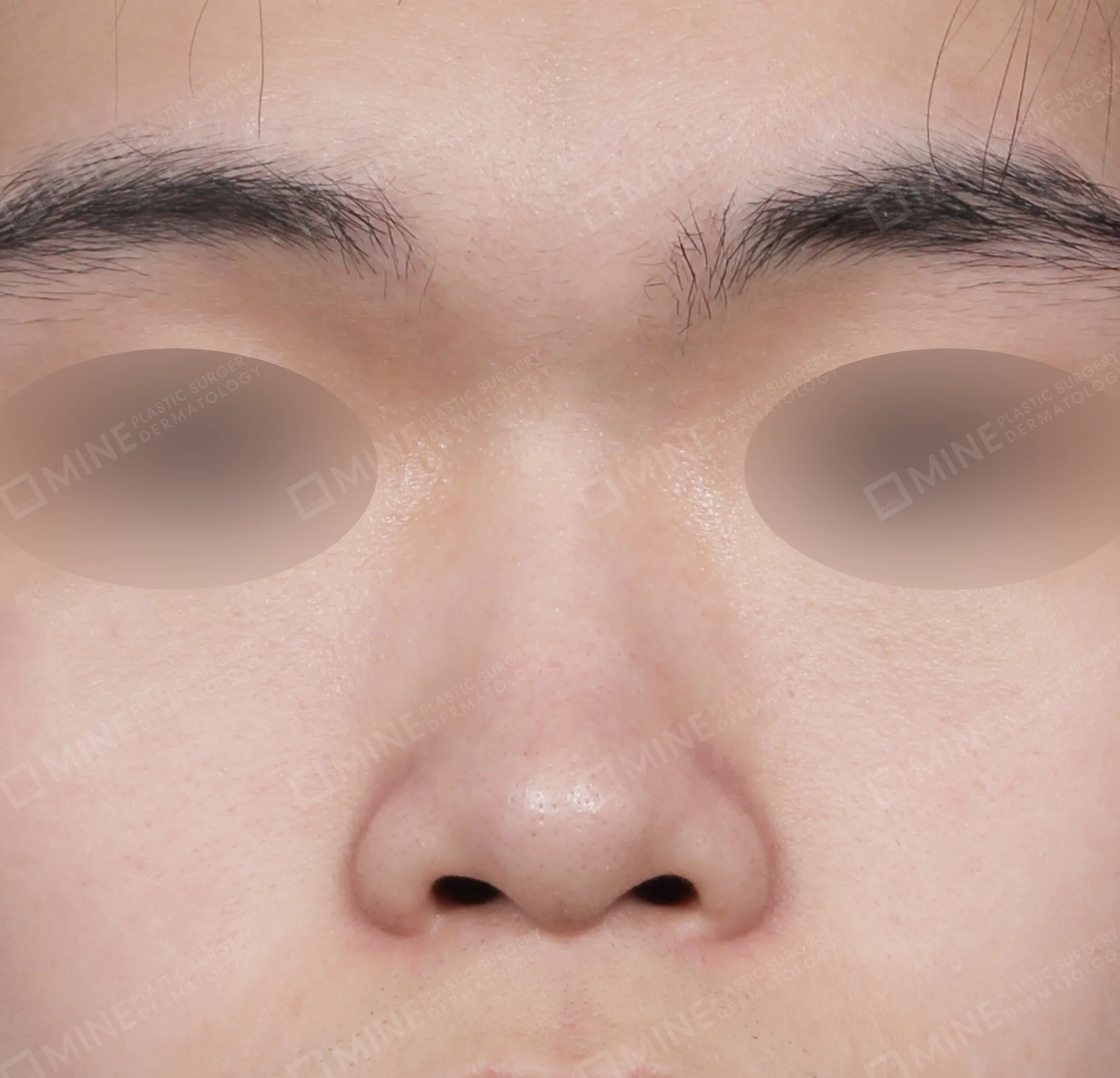 Batang Hidung + Ujung Hidung + Pemanjangan Septum Hidung + Pengurangan Ujung Hidung-Depan-Sebelum