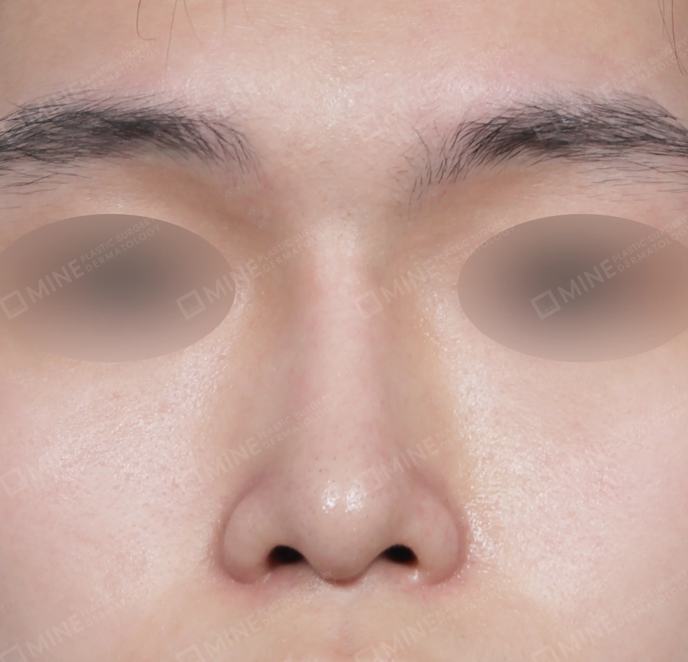 Batang Hidung + Ujung Hidung + Pemanjangan Septum Hidung + Pengurangan Ujung Hidung-Depan-Sesudah