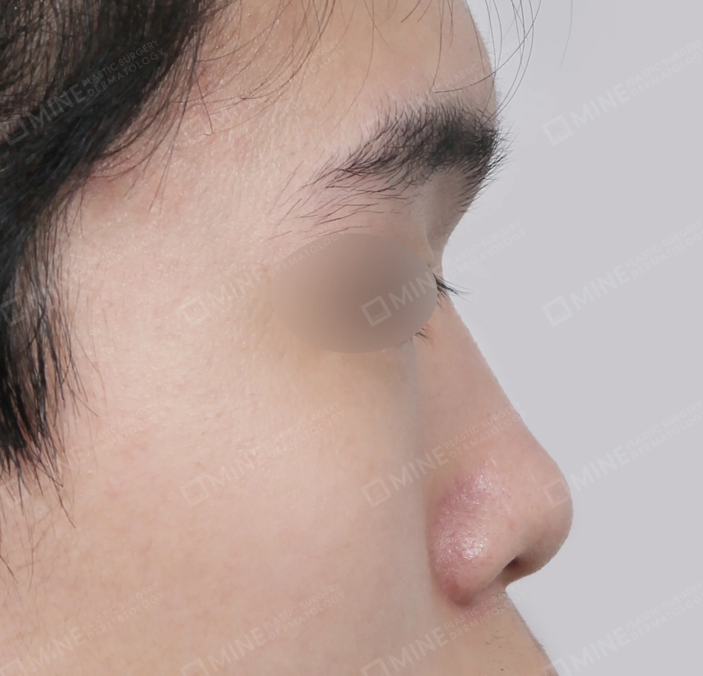 Batang Hidung + Ujung Hidung + Pemanjangan Septum Hidung + Pengurangan Ujung Hidung-Samping-Sebelum