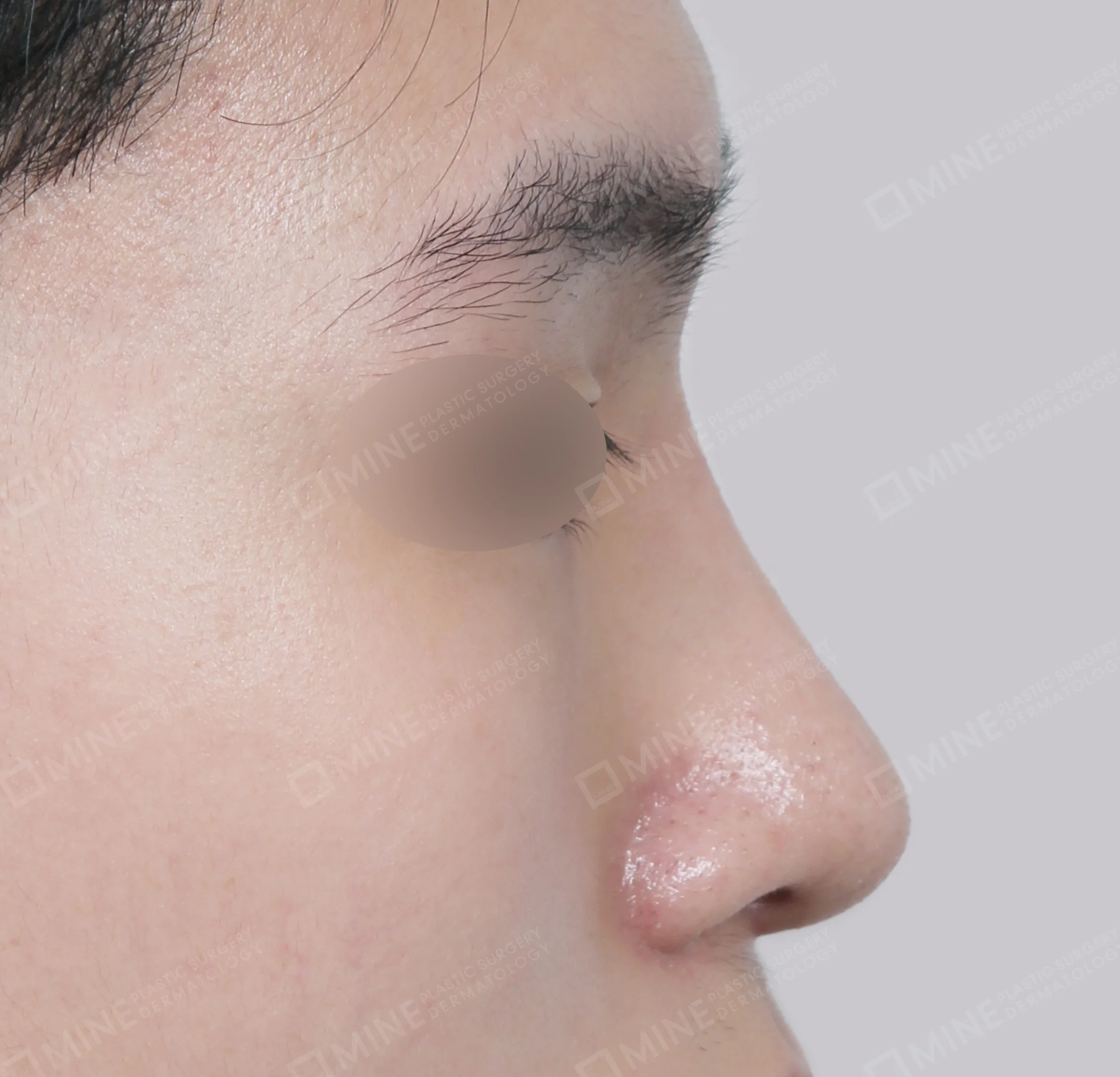 Batang Hidung + Ujung Hidung + Pemanjangan Septum Hidung + Pengurangan Ujung Hidung-Samping-Sesudah