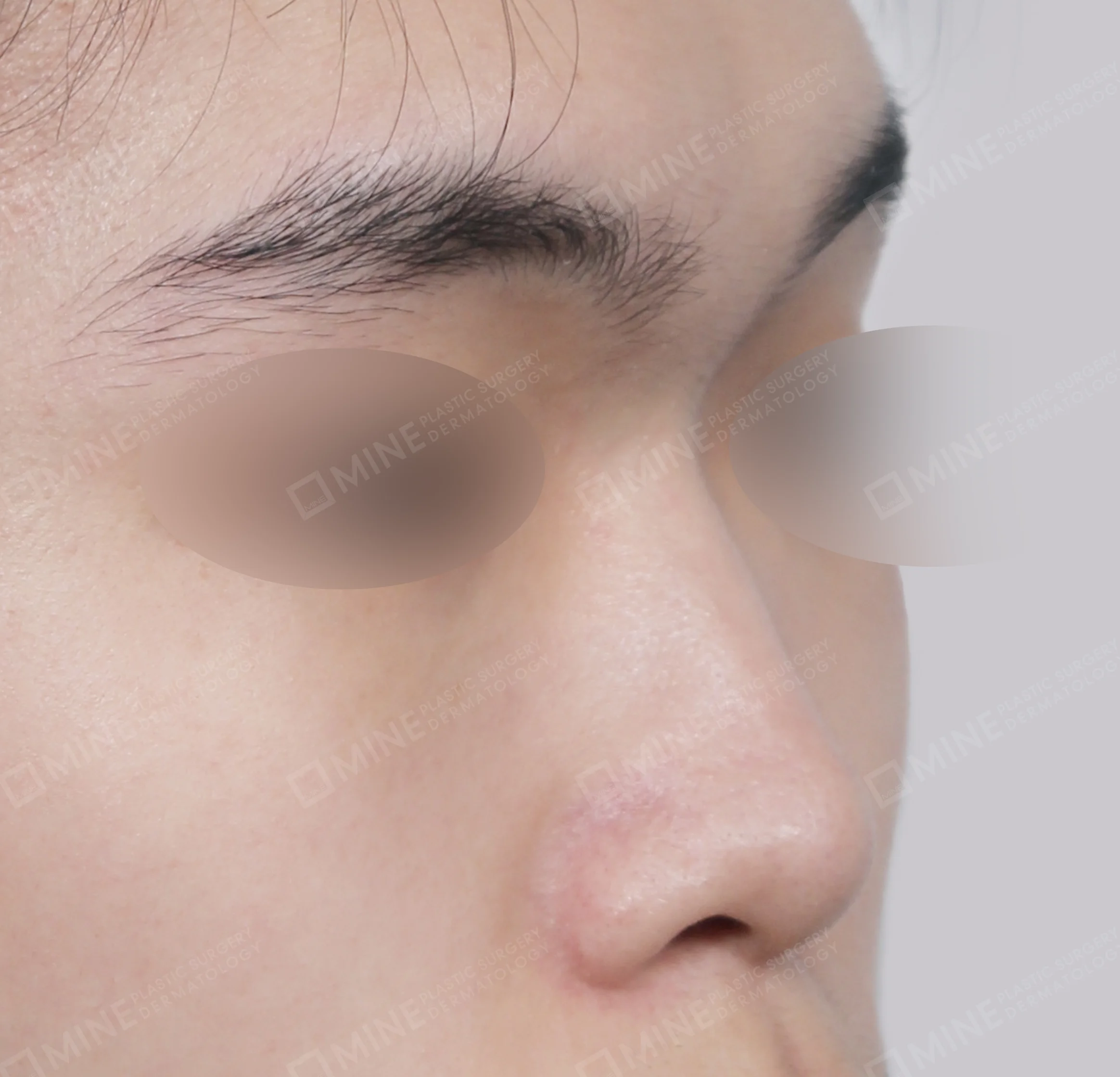 Batang Hidung + Ujung Hidung + Pemanjangan Septum Hidung + Pengurangan Ujung Hidung-45 Derajat-Sebelum