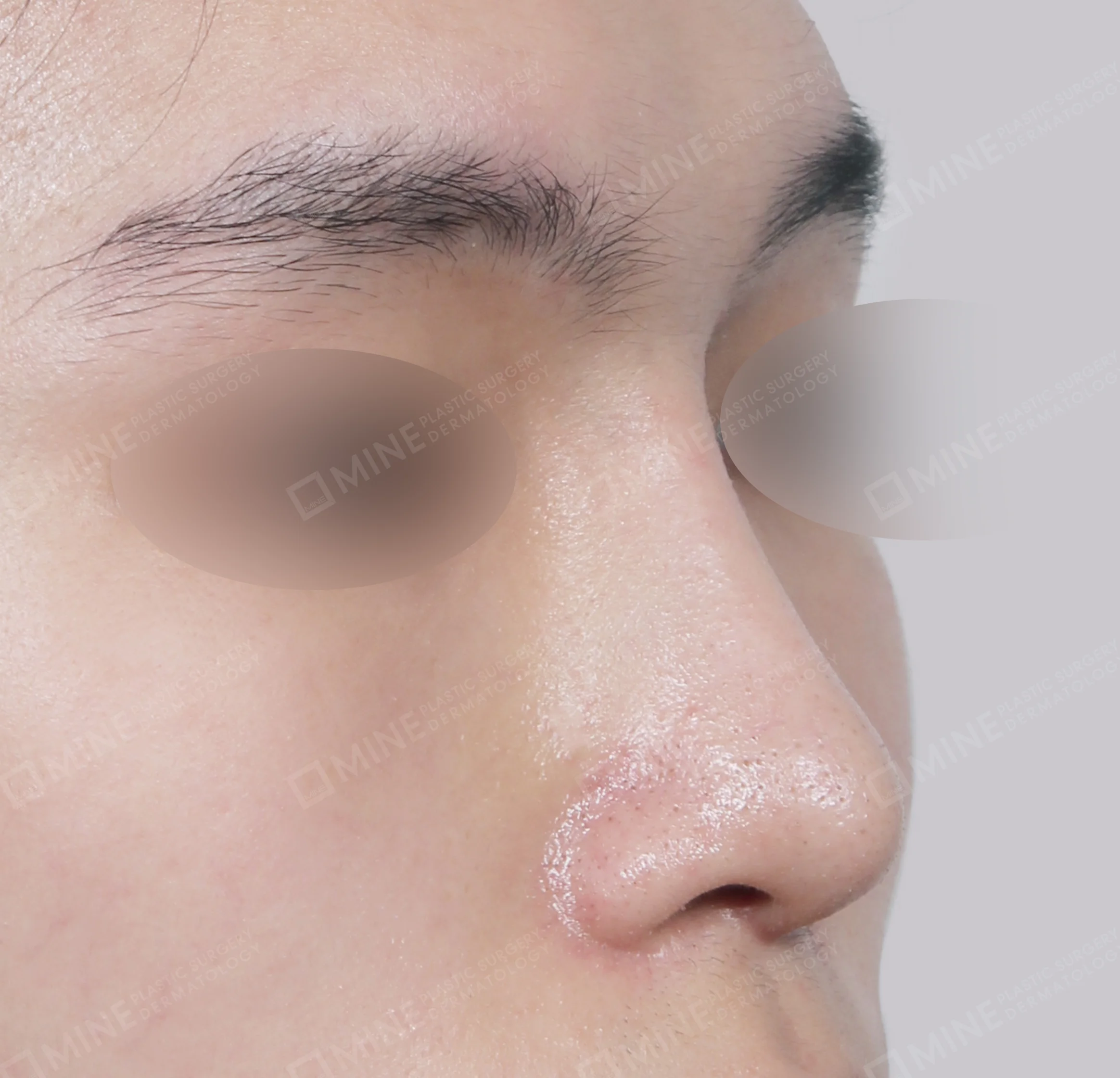 Batang Hidung + Ujung Hidung + Pemanjangan Septum Hidung + Pengurangan Ujung Hidung-45 Derajat-Sesudah