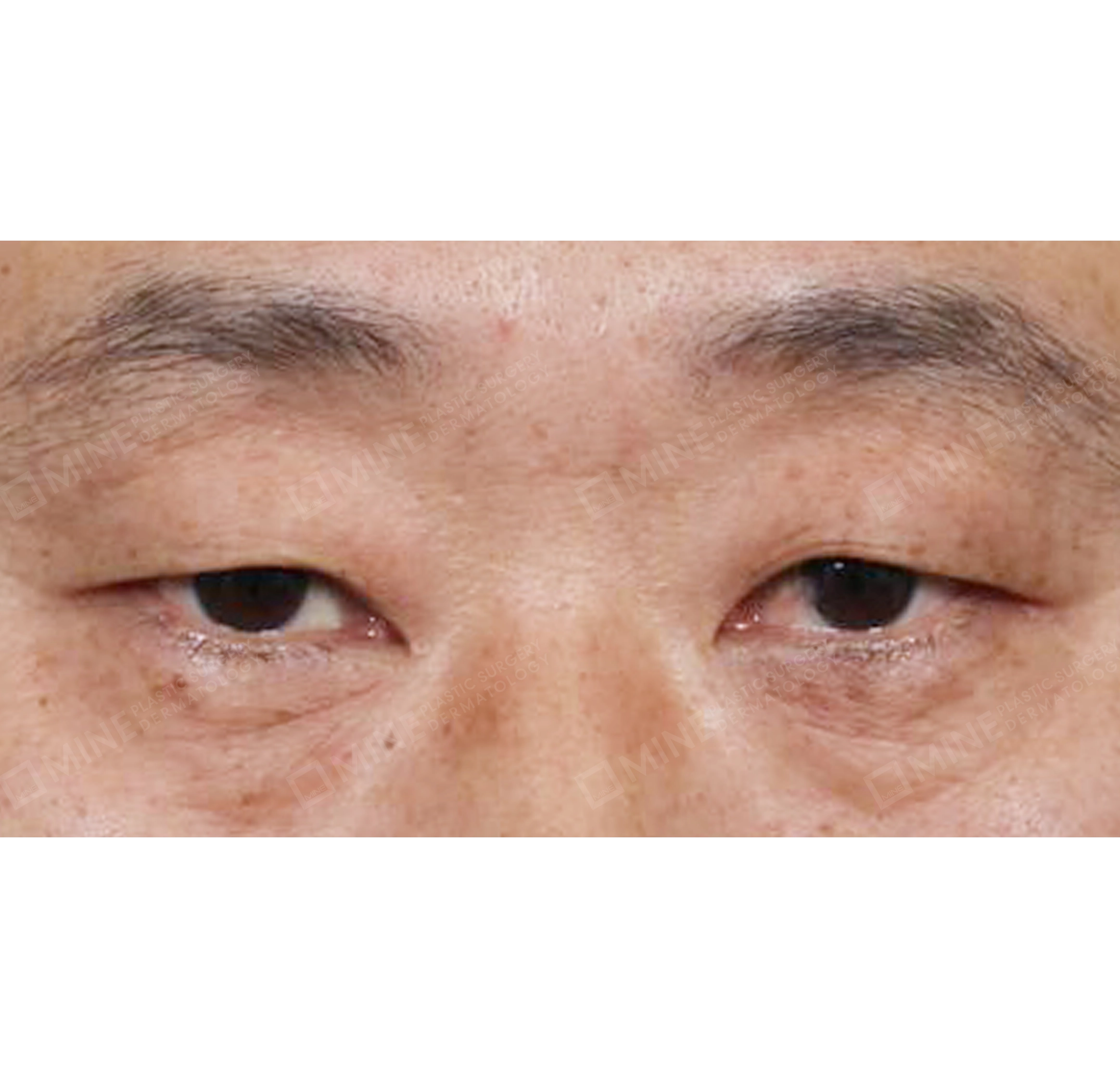 Blepharoplasty Atas-Depan-Sebelum