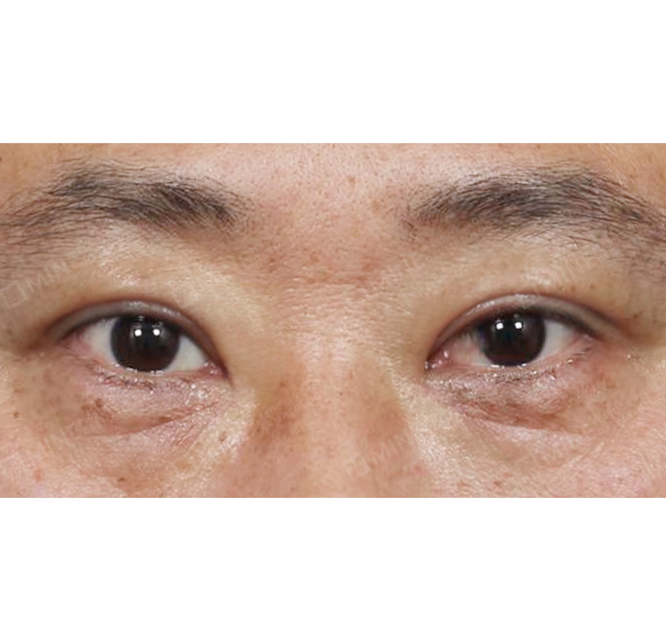 Blepharoplasty Atas-Depan-Sesudah
