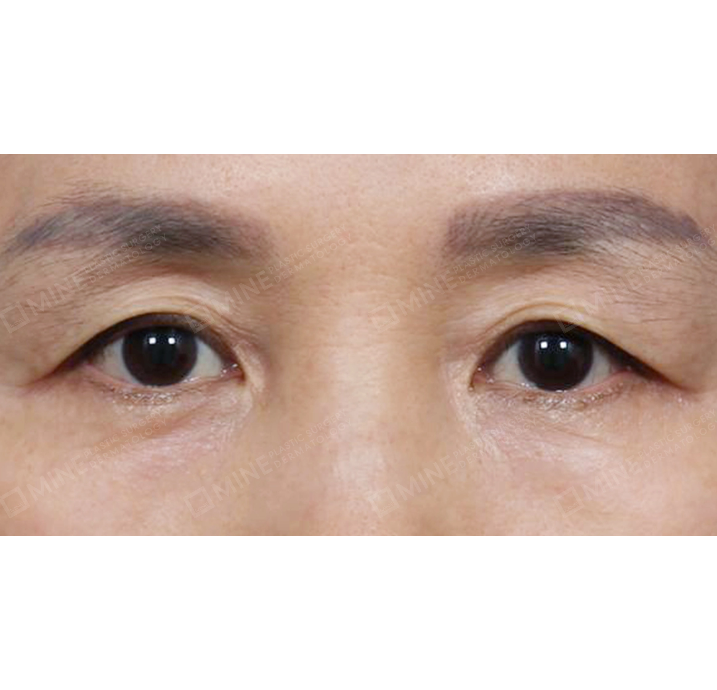 upper & lower blepharoplasty + subbrow lift-Depan-Sebelum