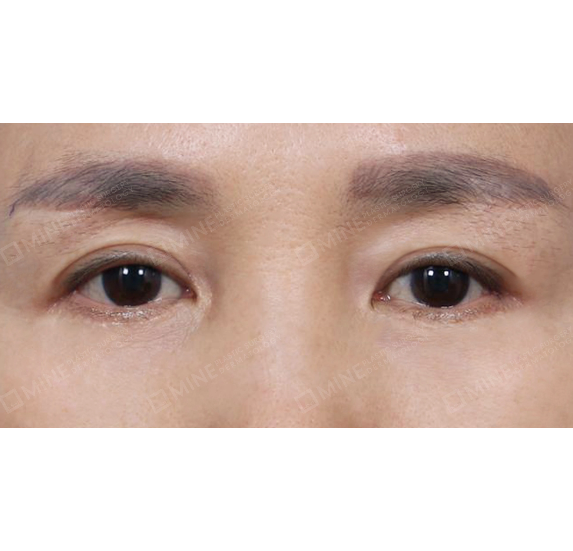 upper & lower blepharoplasty + subbrow lift-Depan-Sesudah