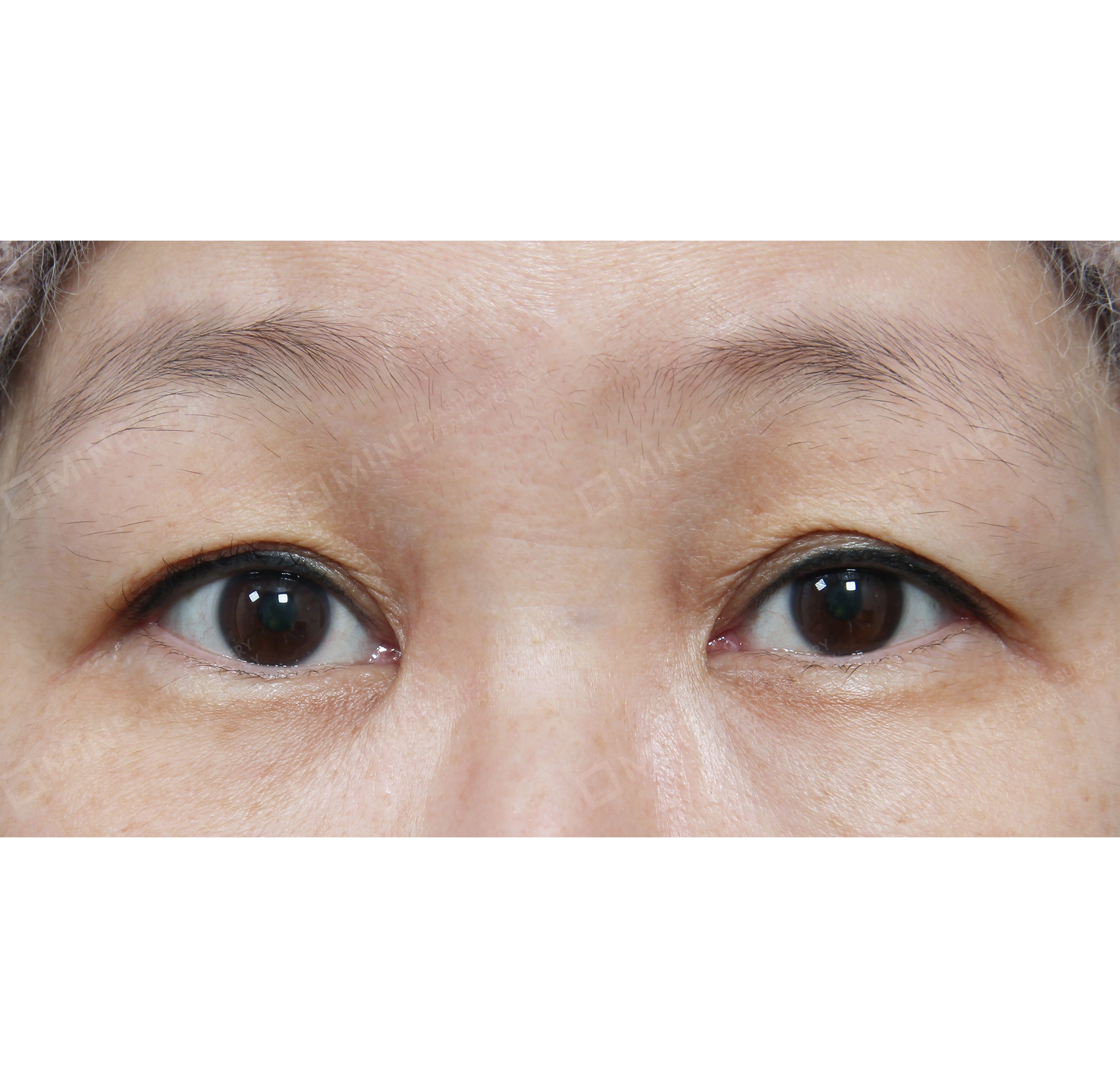 Koreksi Bentuk Mata + Lateral Epi-Canthoplasty-Depan-Sebelum