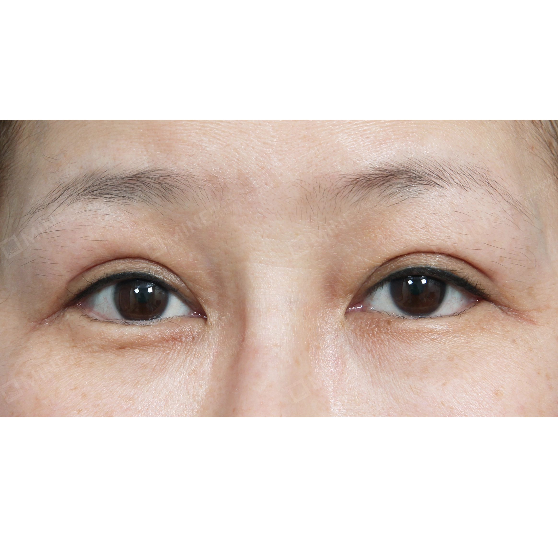 Koreksi Bentuk Mata + Lateral Epi-Canthoplasty-Depan-Sesudah