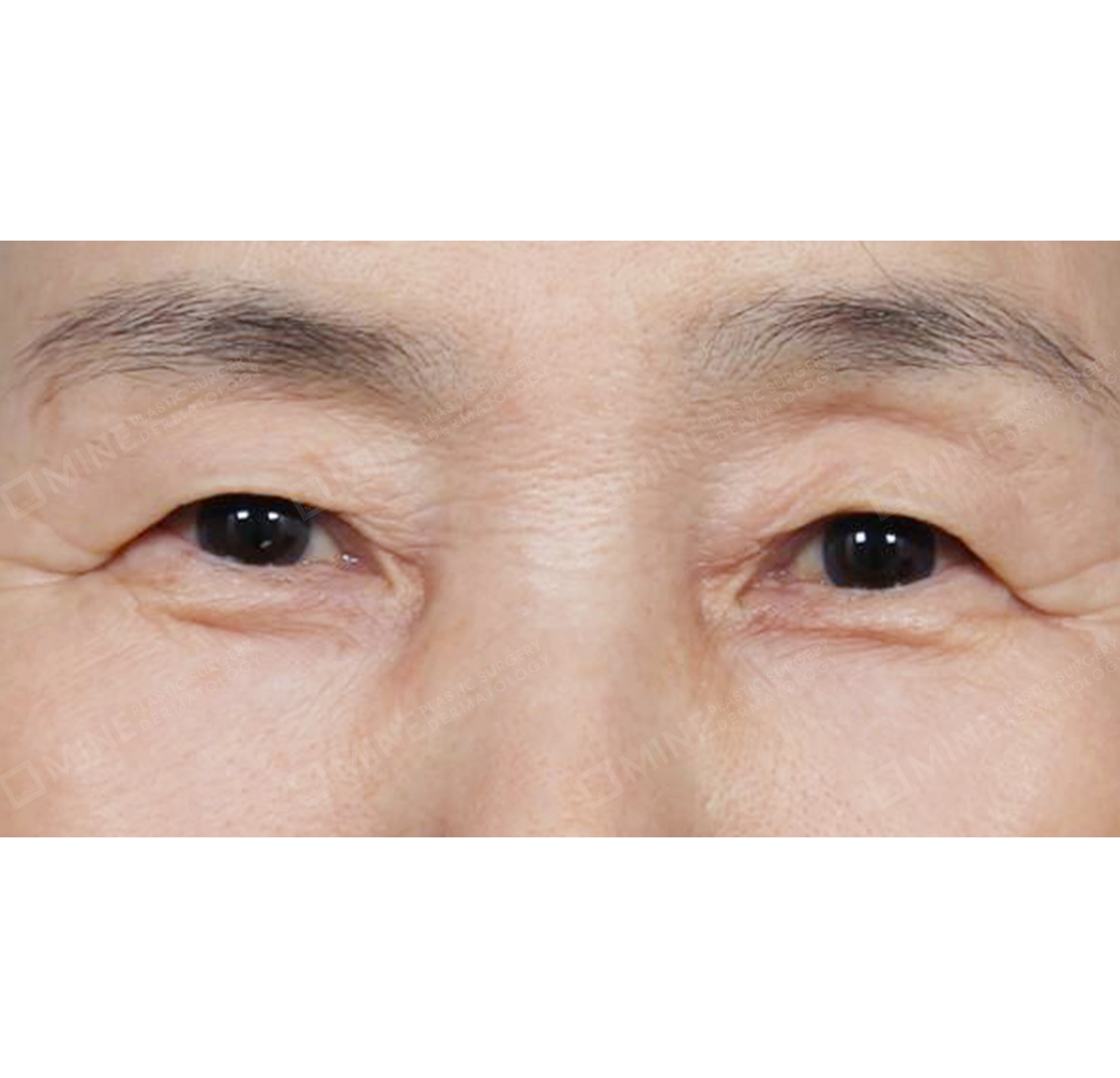 Blepharoplasty Atas + Aransemen Lemak di Lipatan Mata-Depan-Sebelum