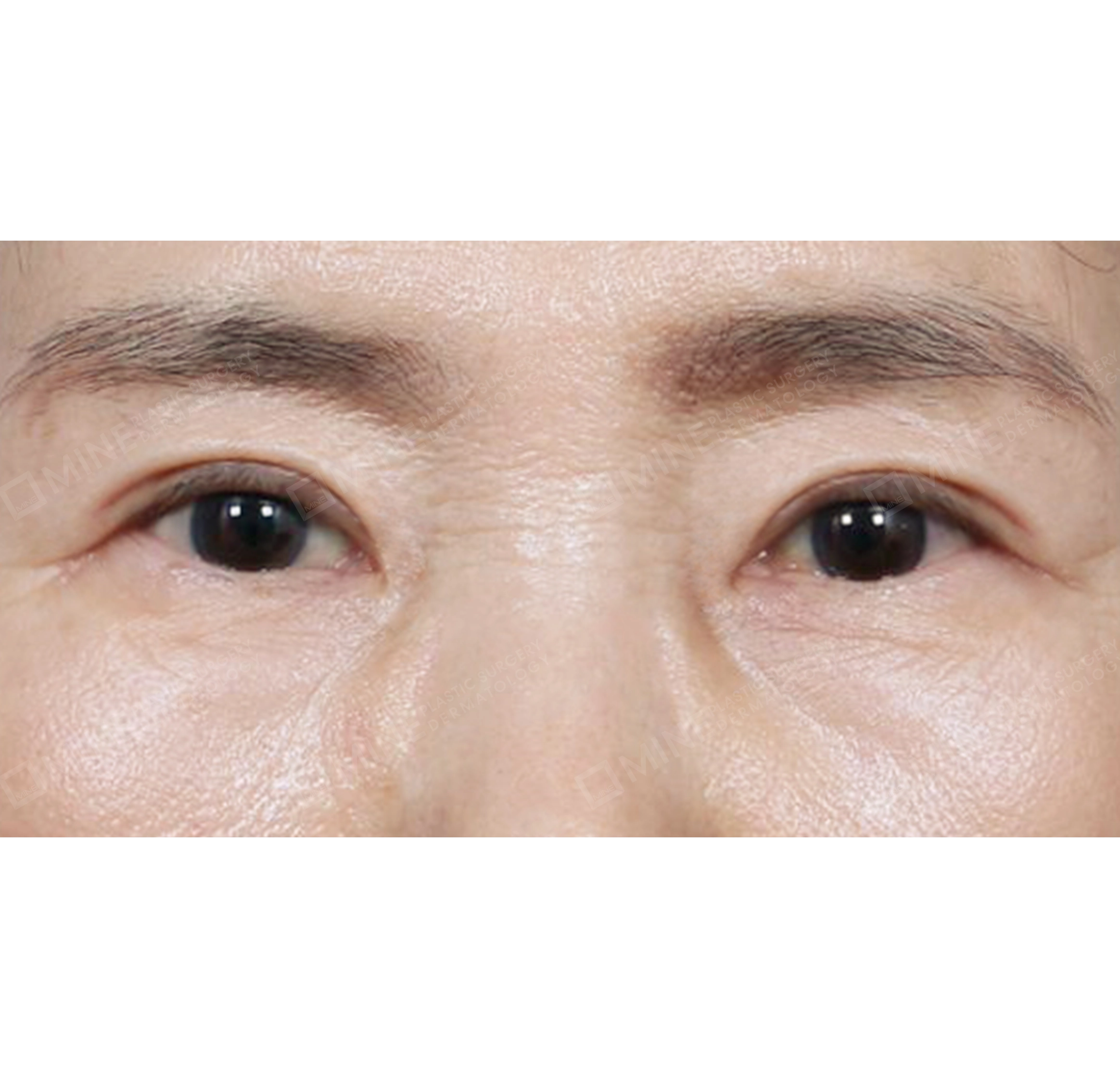 Blepharoplasty Atas + Aransemen Lemak di Lipatan Mata-Depan-Sesudah