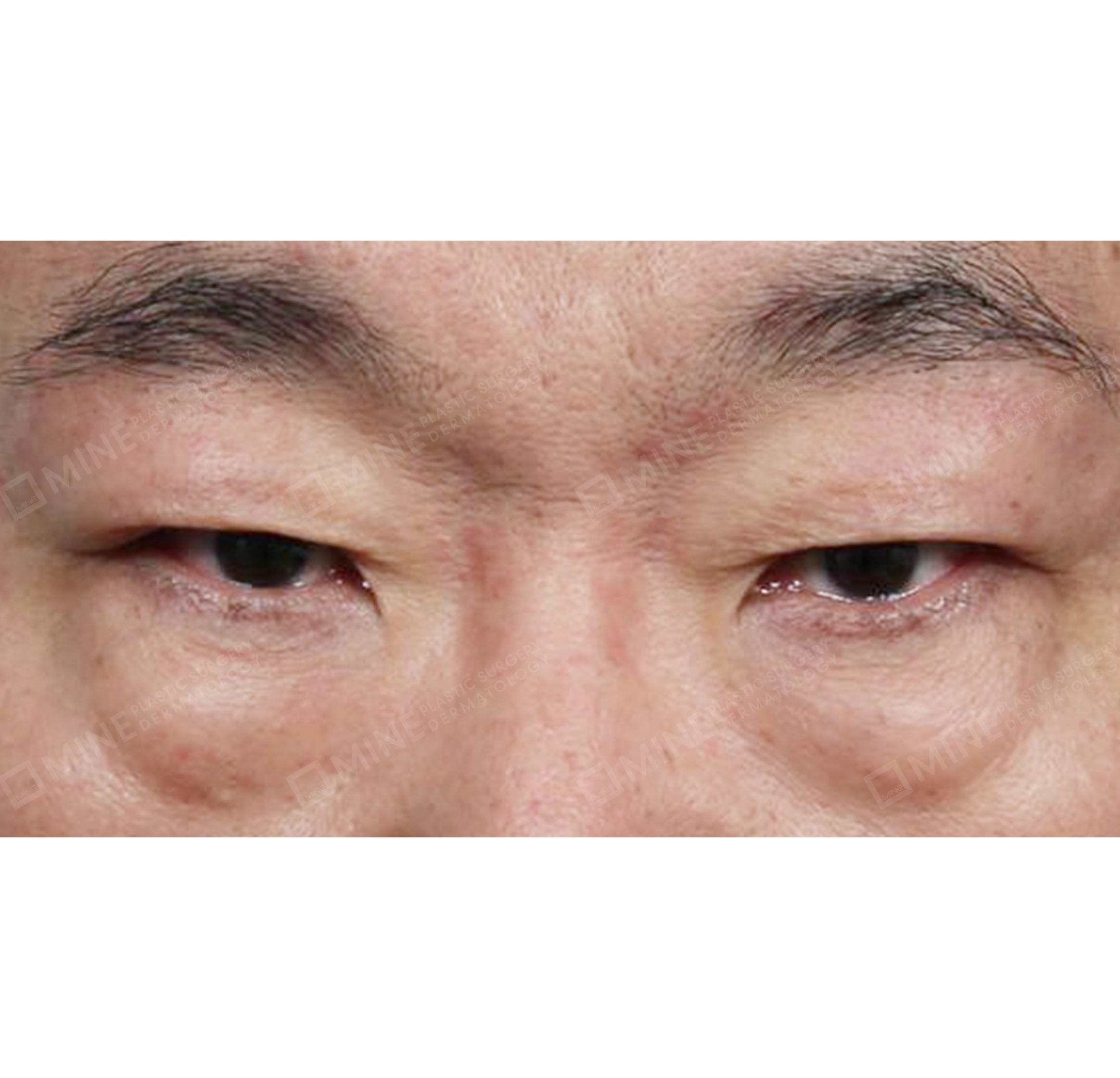 Lifting Bawah Alis + Blepharoplasty Bawah + Pembuangan Lemak Kelopak Mata Atas-Depan-Sebelum
