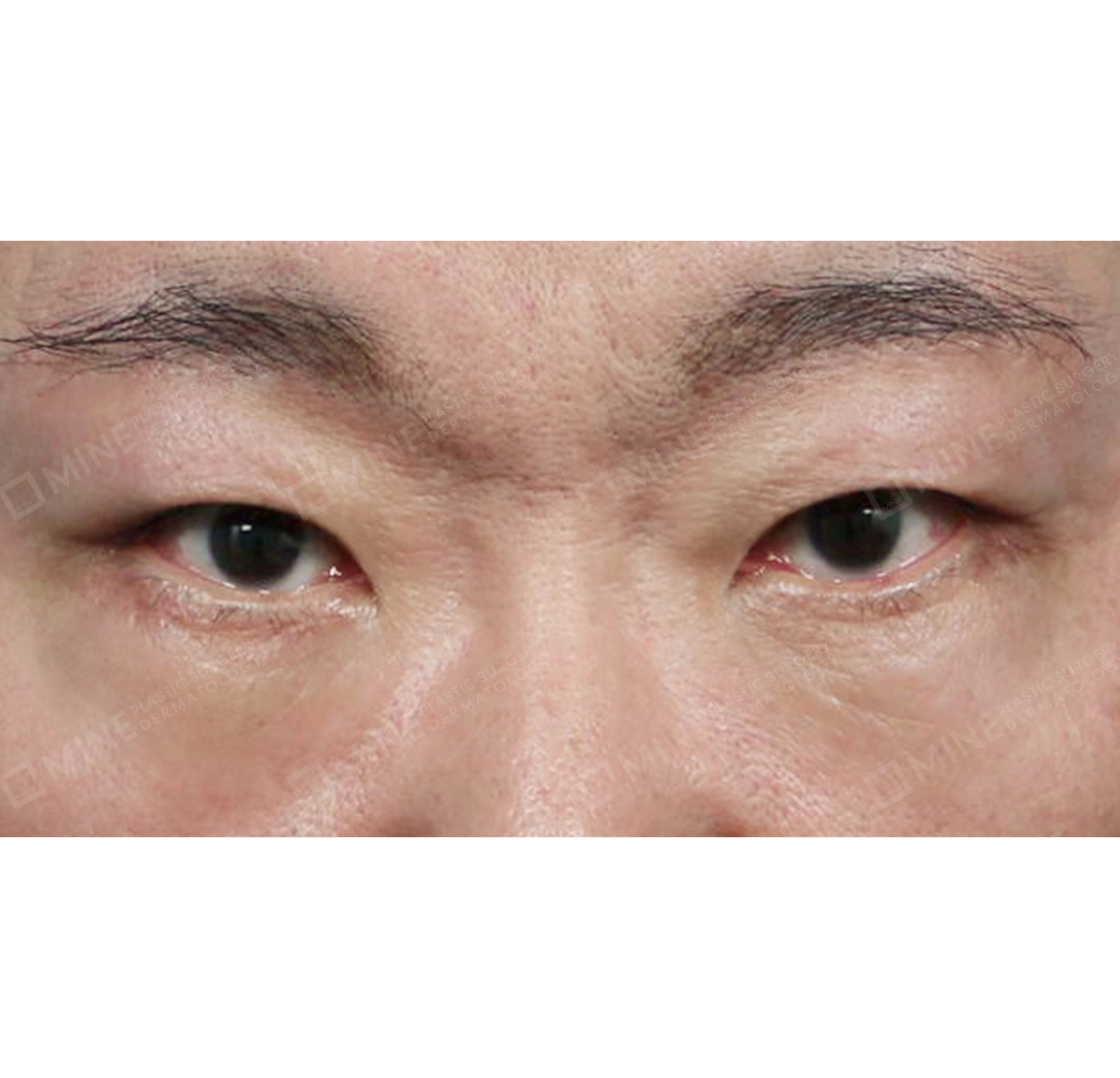 Lifting Bawah Alis + Blepharoplasty Bawah + Pembuangan Lemak Kelopak Mata Atas-Depan-Sesudah