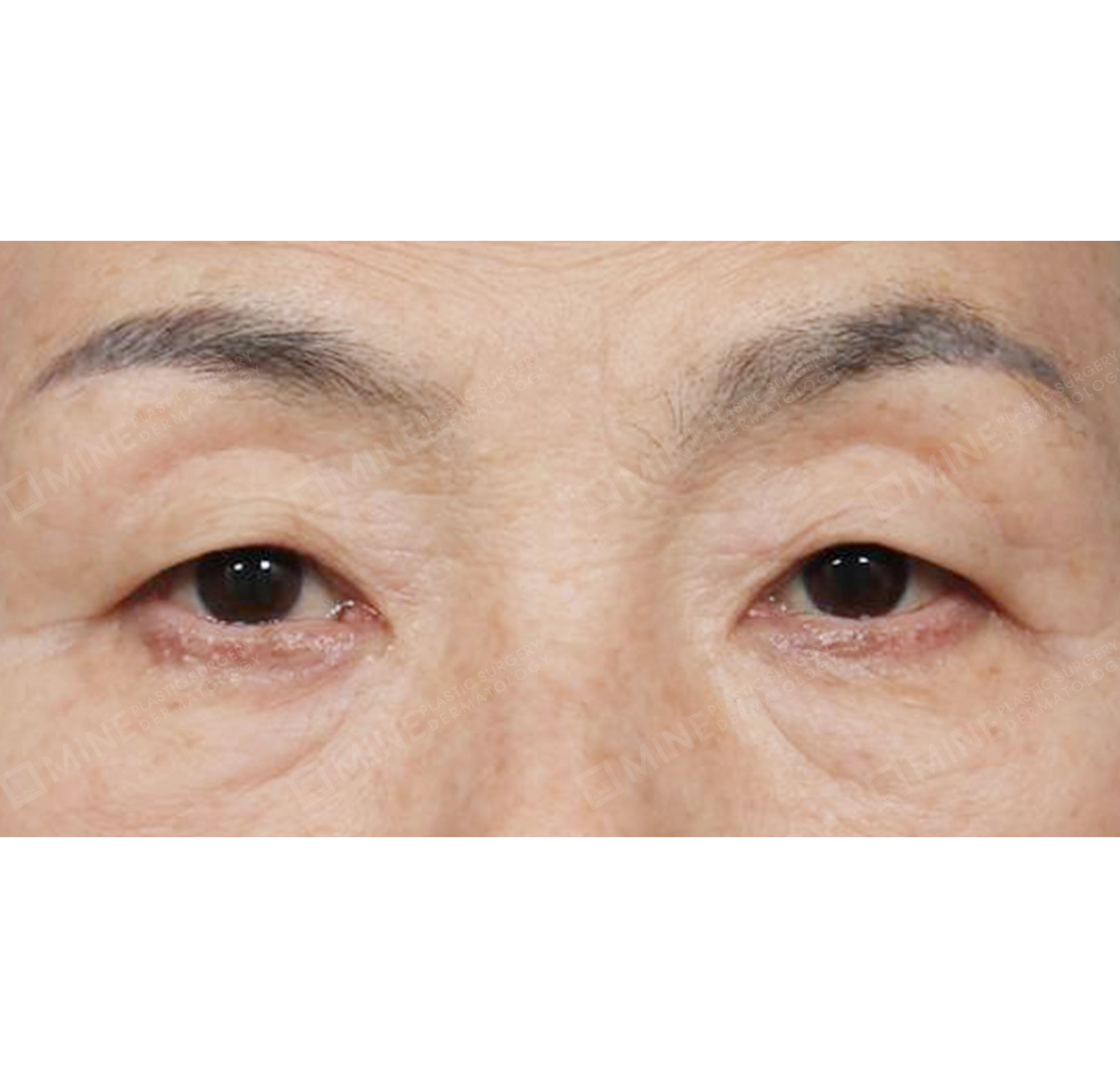 Blepharoplasty Atas + Blepharoplasty Bawah + Lifting Bawah Alis-Depan-Sebelum