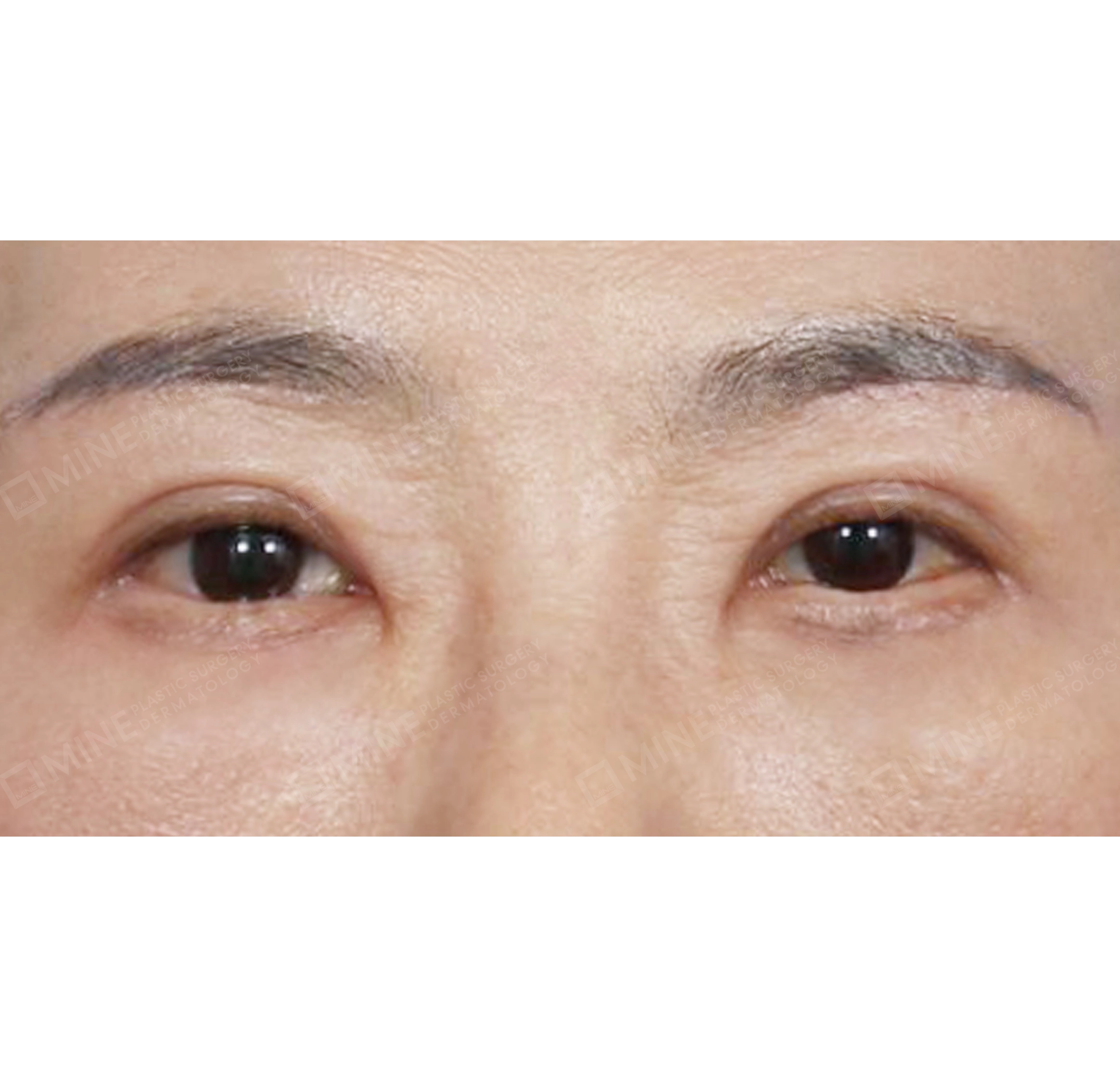 Blepharoplasty Atas + Blepharoplasty Bawah + Lifting Bawah Alis-Depan-Sesudah