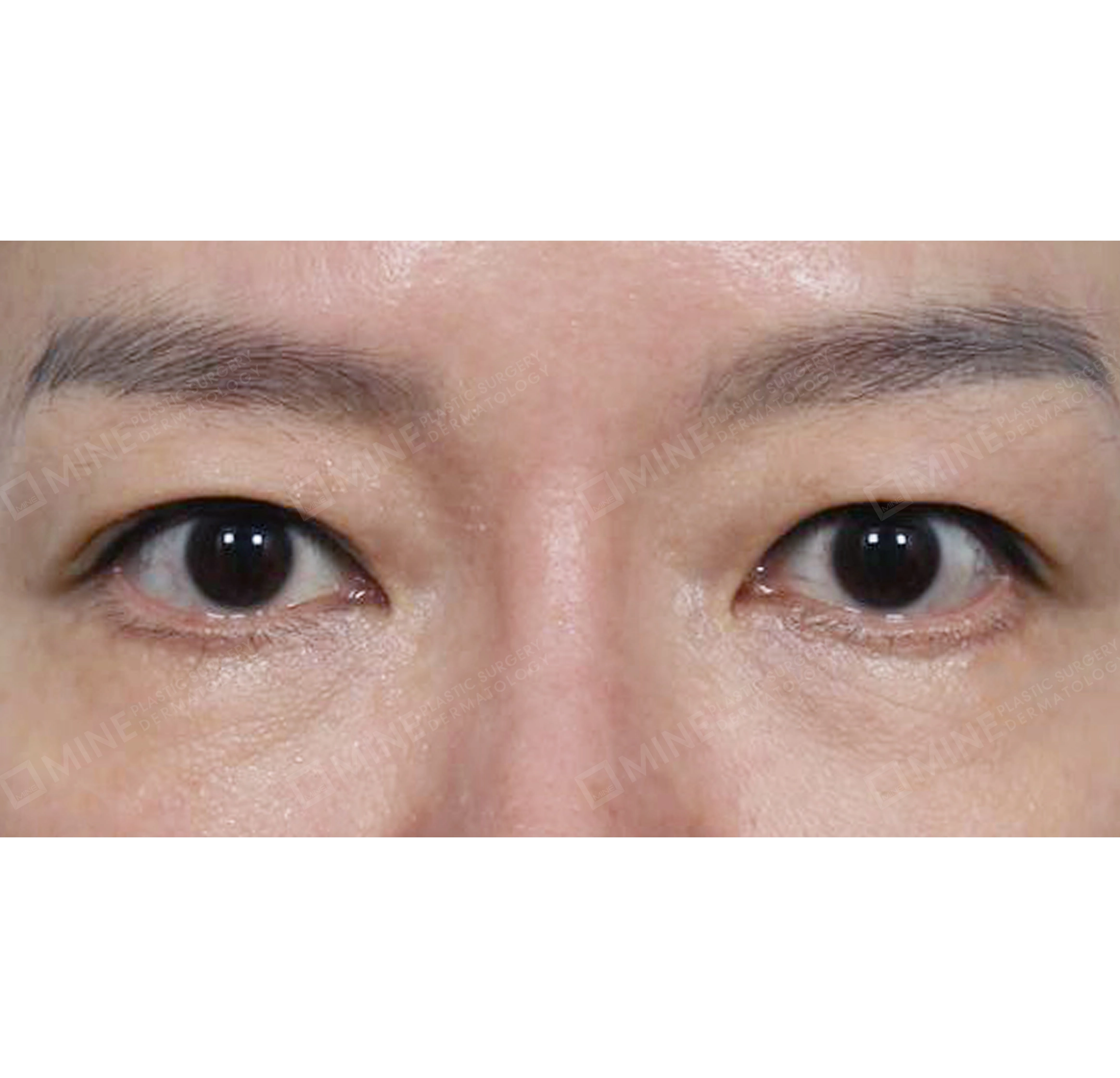 Lifting Bawah Alis + Revisi Blepharoplasty Bawah-Depan-Sebelum