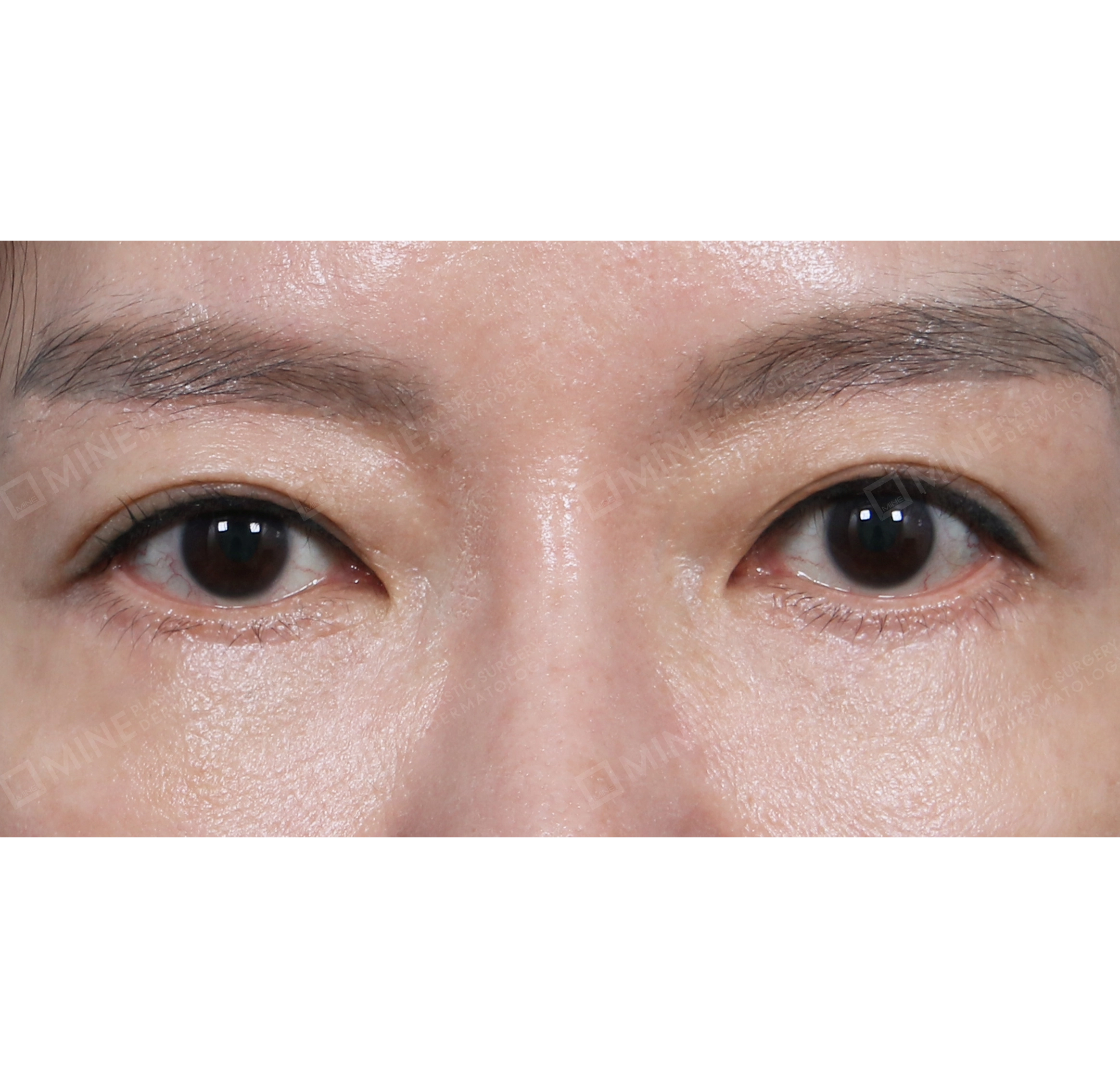 Lifting Bawah Alis + Revisi Blepharoplasty Bawah-Depan-Sesudah