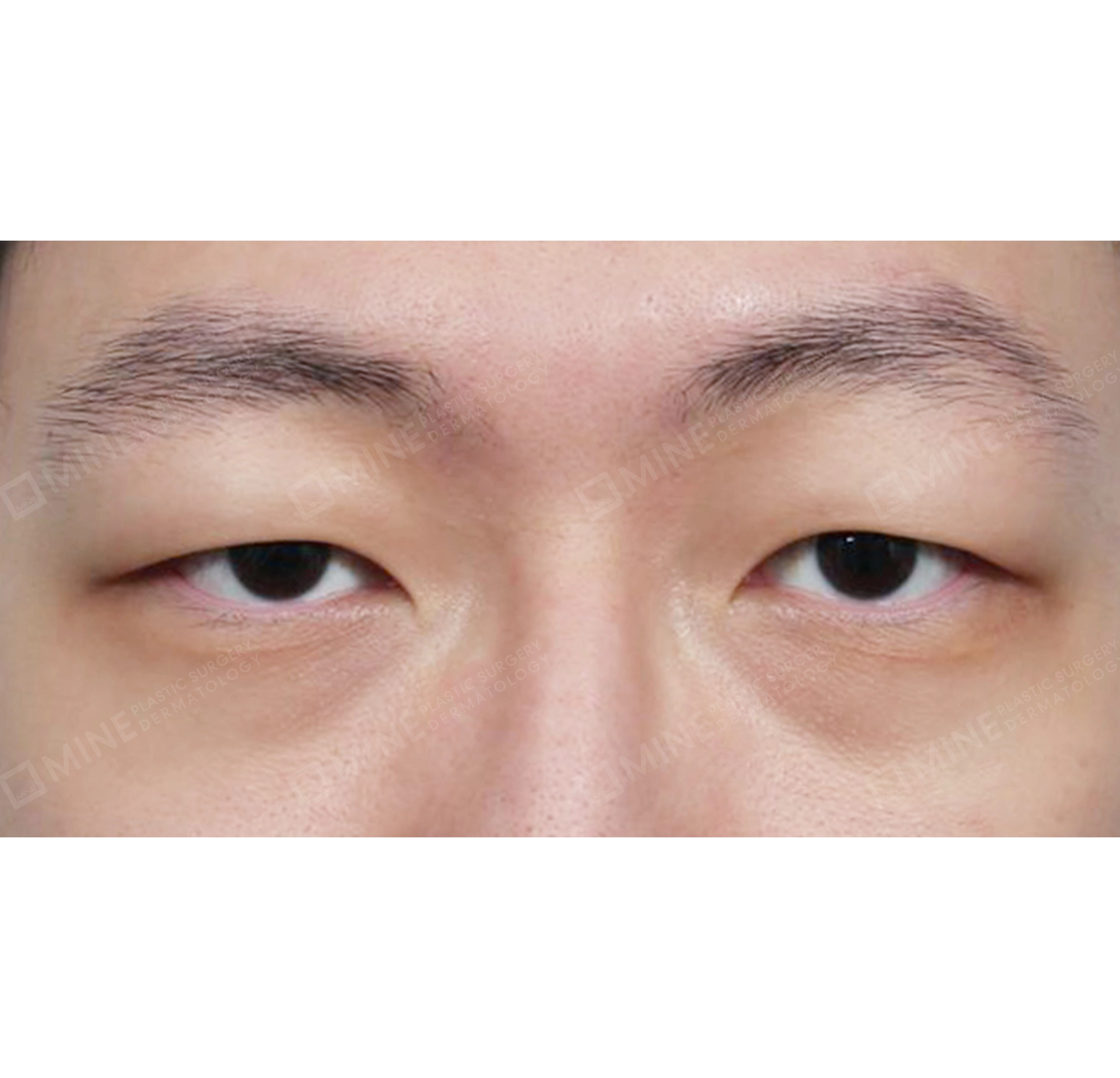 Koreksi Ptosis Insisi-Depan-Sebelum