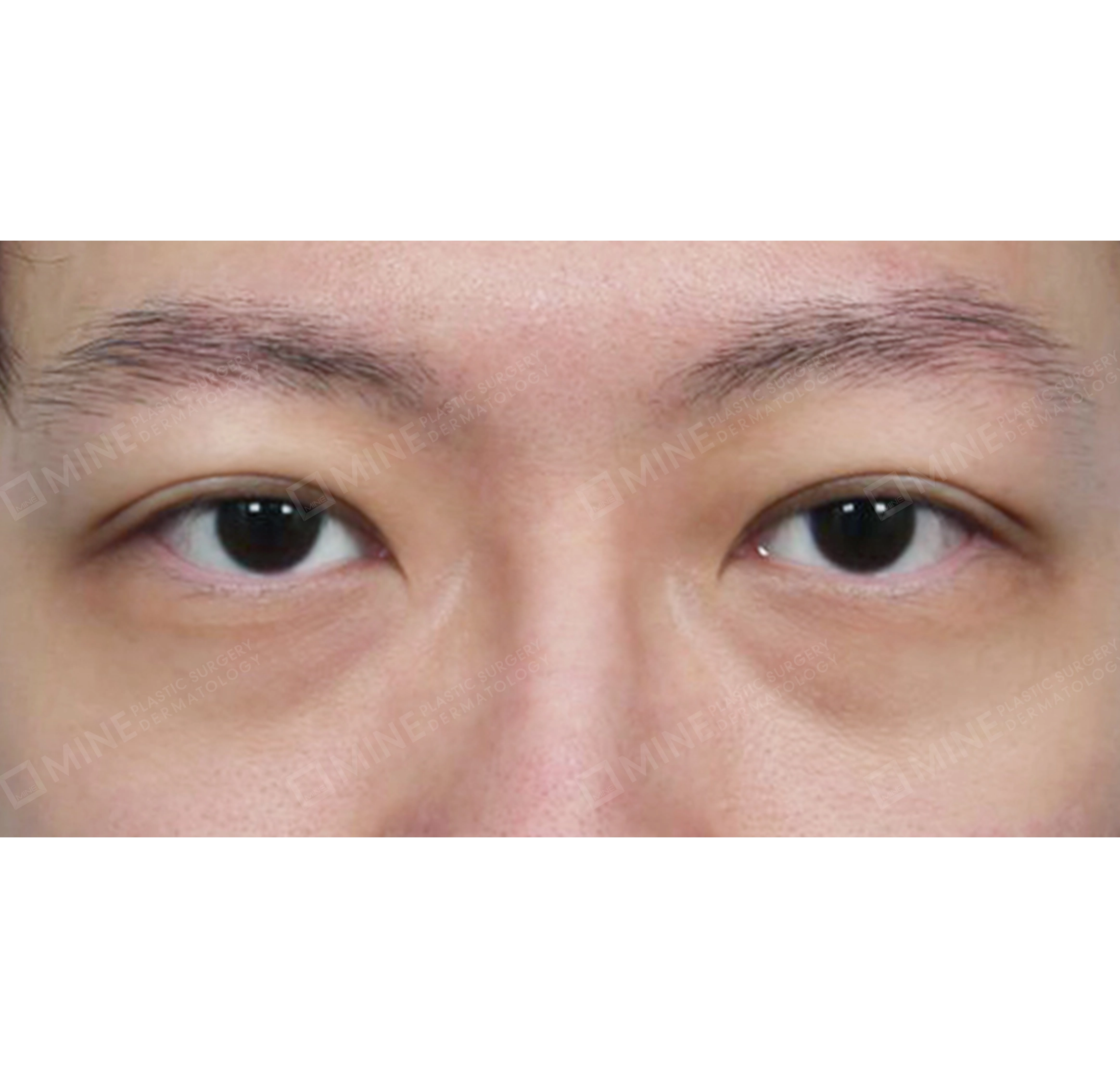 Koreksi Ptosis Insisi-Depan-Sesudah