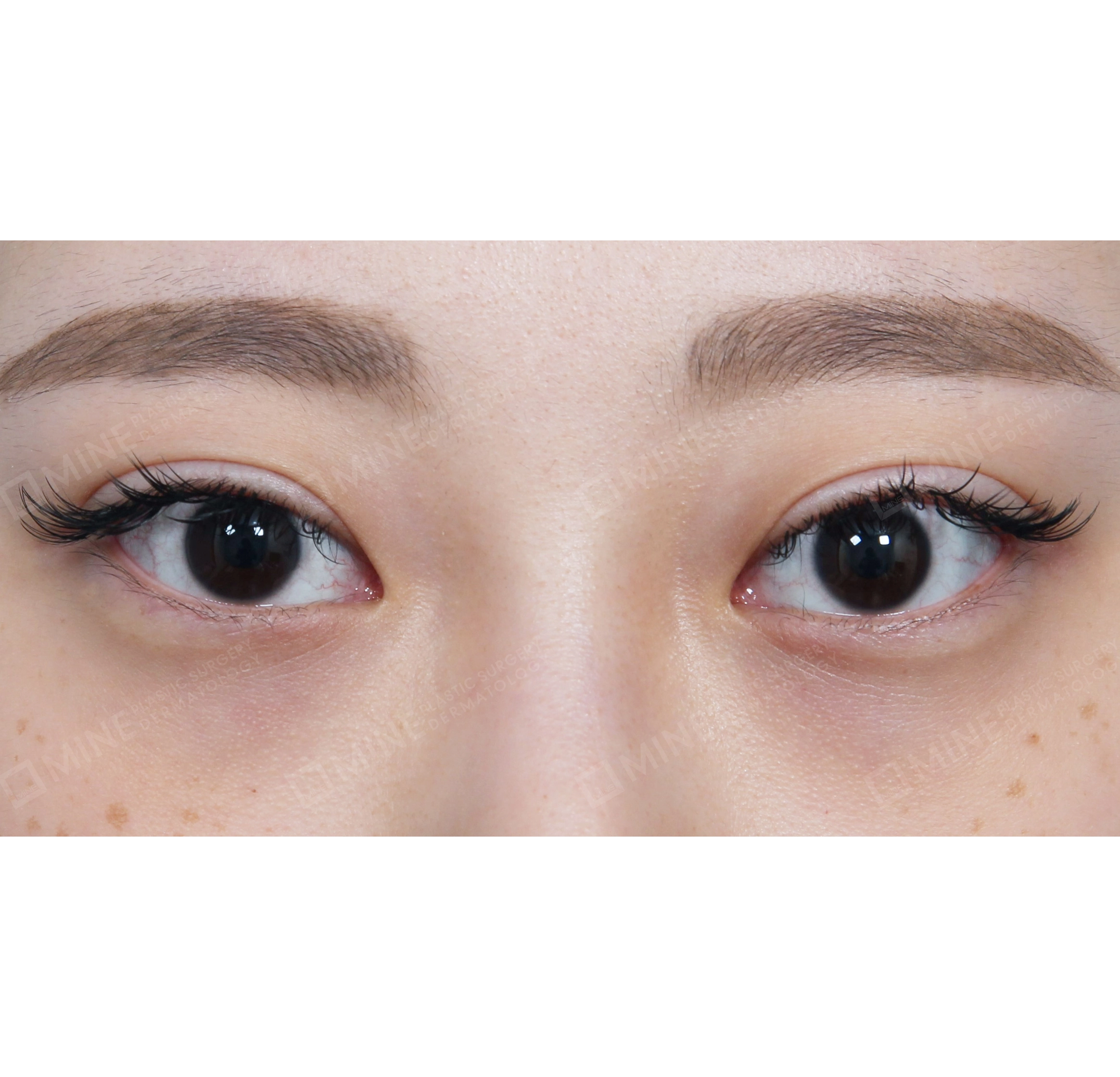 Lateral Canthoplasty-Depan-Sebelum