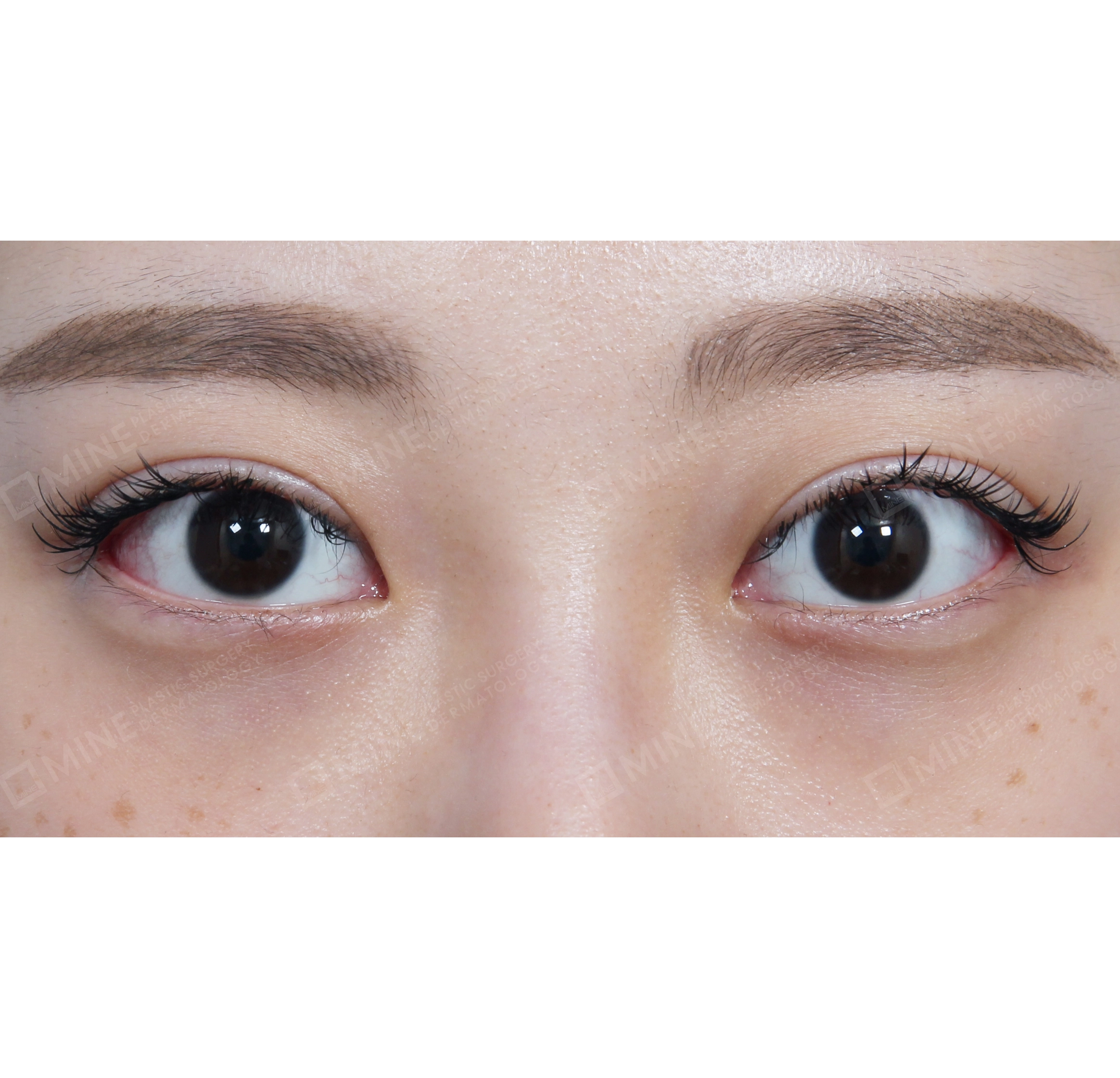 Lateral Canthoplasty-Depan-Sesudah