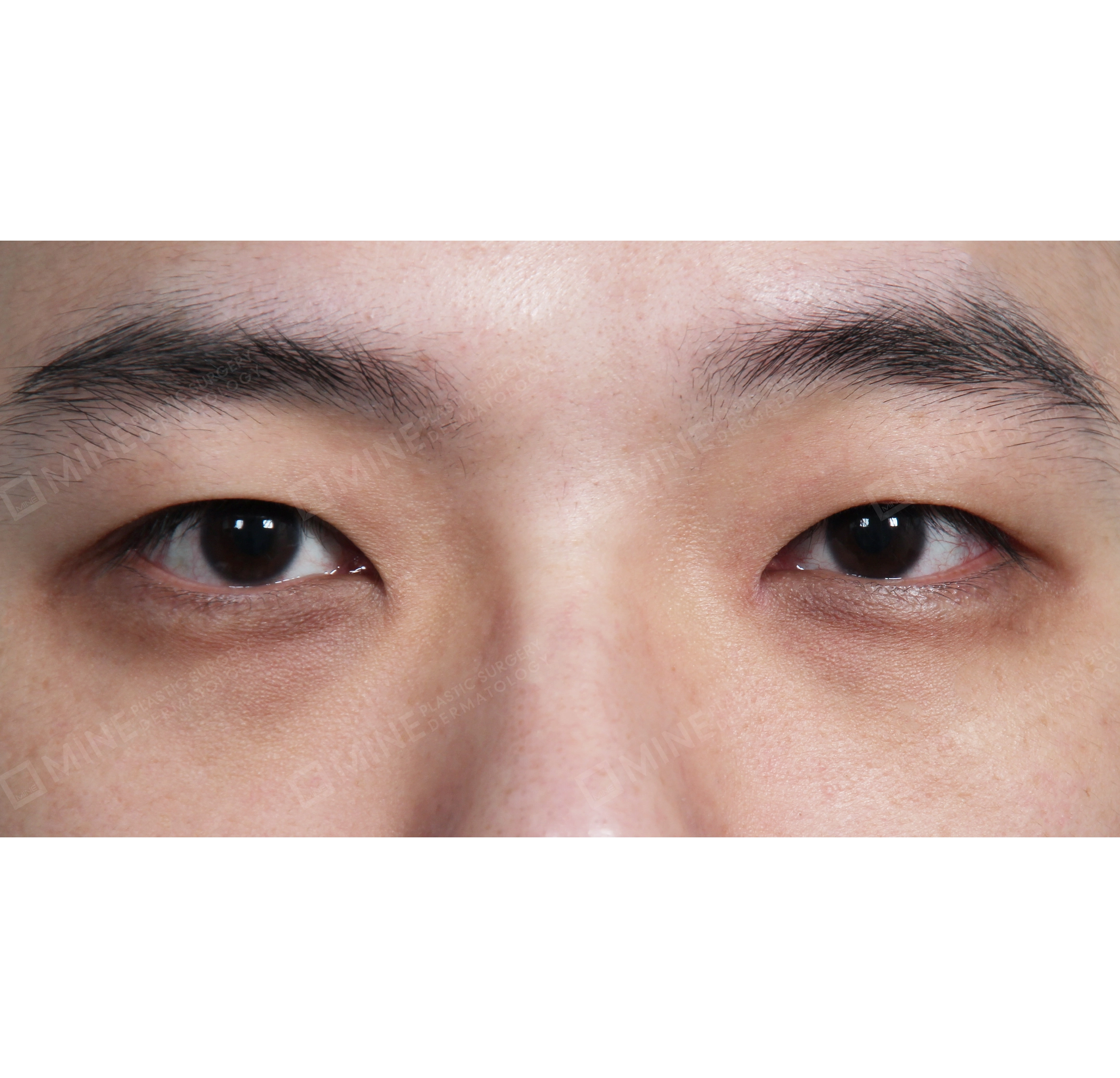 Lipatan Mata Ganda Non Insisi + Epi-Canthoplasty-Depan-Sebelum